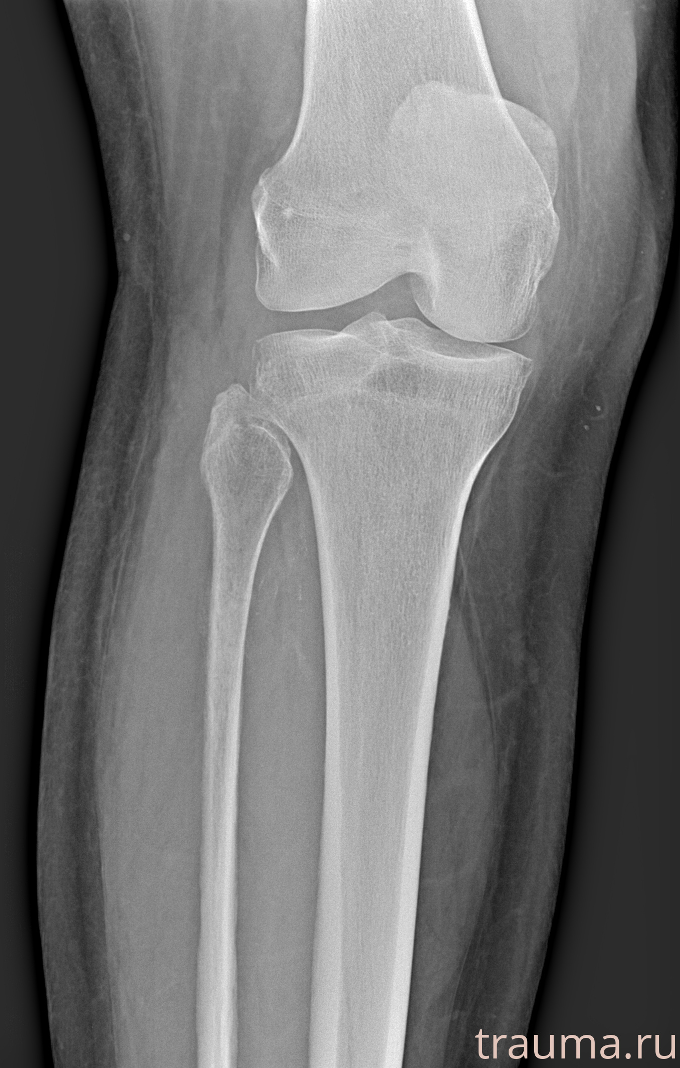 Рентген на дому: по вашему адресу приезжает врач-рентгенолог, травматолог-ортопед с мобильным рентгеновским аппаратом, проводит диагностику травмы или заболевания, делает необходимые рентгенограммы, дает рекомендации по дальнейшему лечению. Получить качественные снимки в домашних условиях возможно благодаря уникальной методике, разработанной МосРентген Центром для института  Склифосовского