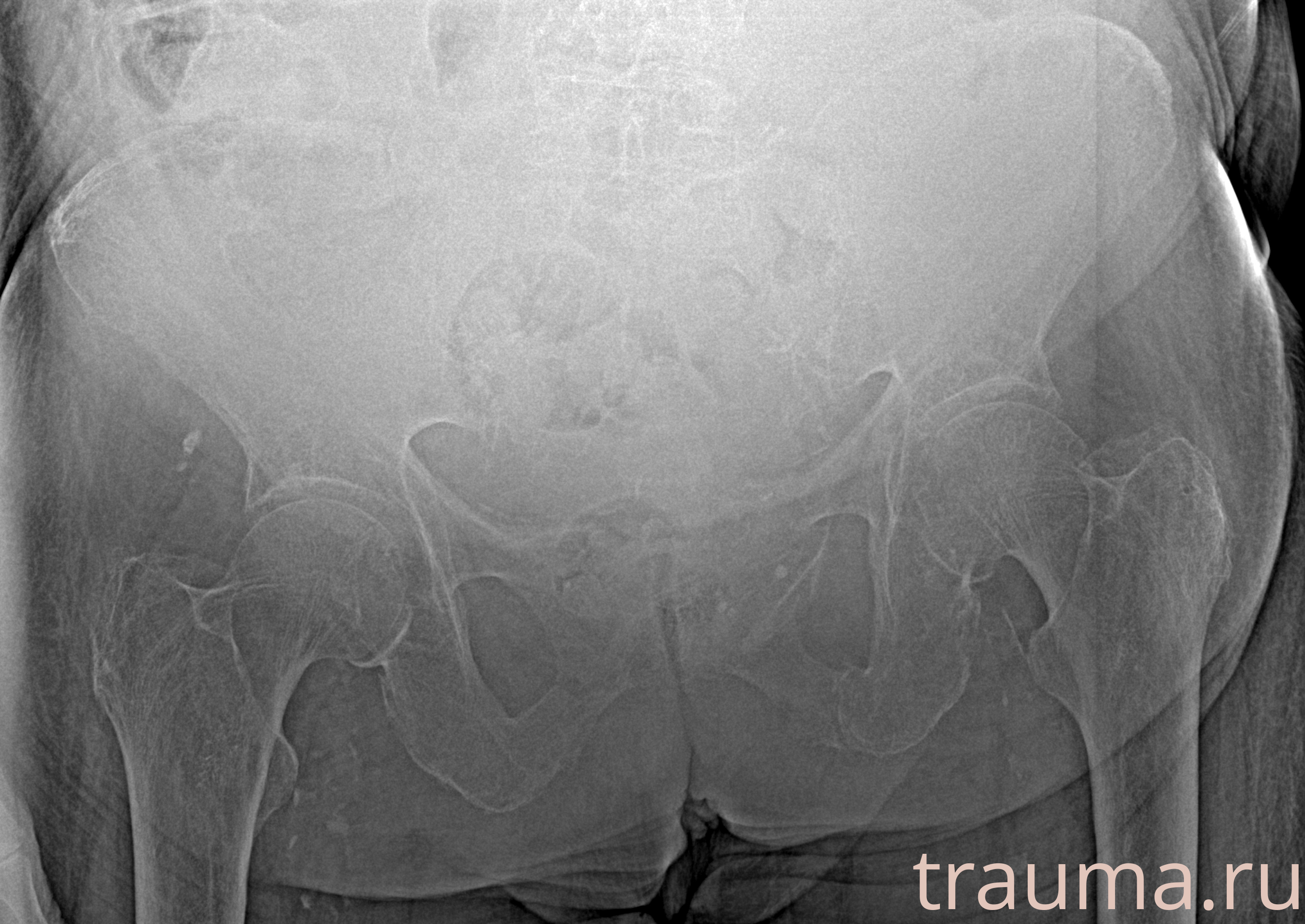 Рентген на дому: по вашему адресу приезжает врач-рентгенолог, травматолог-ортопед с мобильным рентгеновским аппаратом, проводит диагностику травмы или заболевания, делает необходимые рентгенограммы, дает рекомендации по дальнейшему лечению. Получить качественные снимки в домашних условиях возможно благодаря уникальной методике, разработанной МосРентген Центром для института  Склифосовского