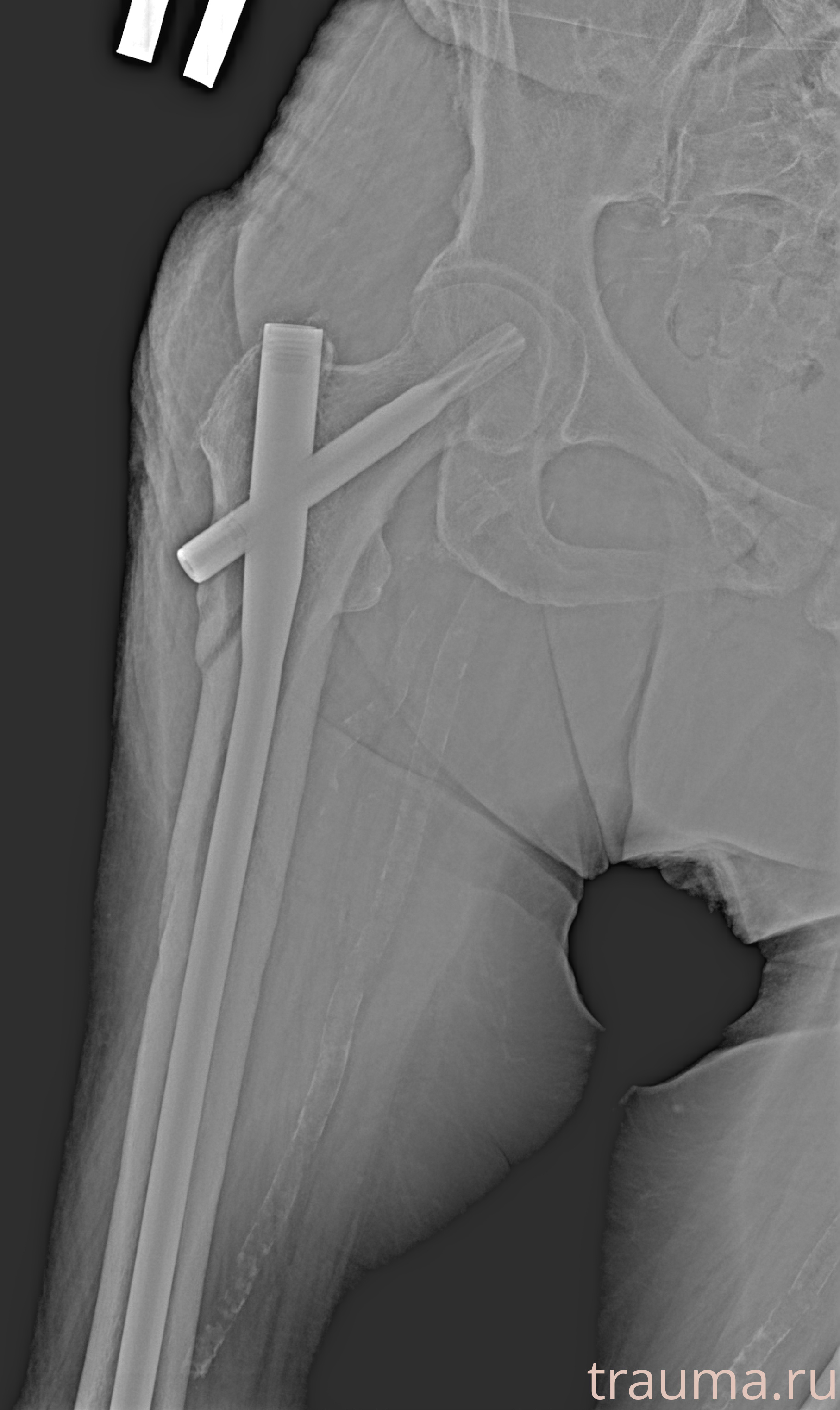 Рентген на дому: по вашему адресу приезжает врач-рентгенолог, травматолог-ортопед с мобильным рентгеновским аппаратом, проводит диагностику травмы или заболевания, делает необходимые рентгенограммы, дает рекомендации по дальнейшему лечению. Получить качественные снимки в домашних условиях возможно благодаря уникальной методике, разработанной МосРентген Центром для института  Склифосовского