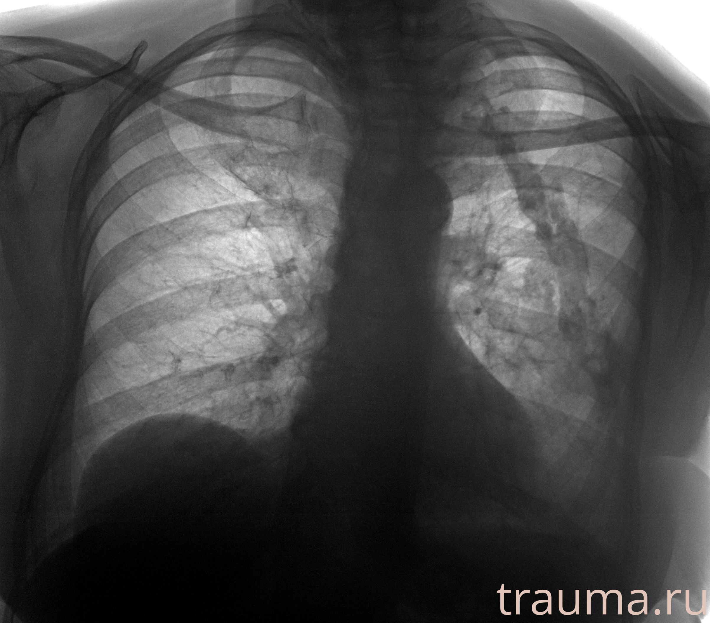 Рентген на дому: по вашему адресу приезжает врач-рентгенолог, травматолог-ортопед с мобильным рентгеновским аппаратом, проводит диагностику травмы или заболевания, делает необходимые рентгенограммы, дает рекомендации по дальнейшему лечению. Получить качественные снимки в домашних условиях возможно благодаря уникальной методике, разработанной МосРентген Центром для института  Склифосовского