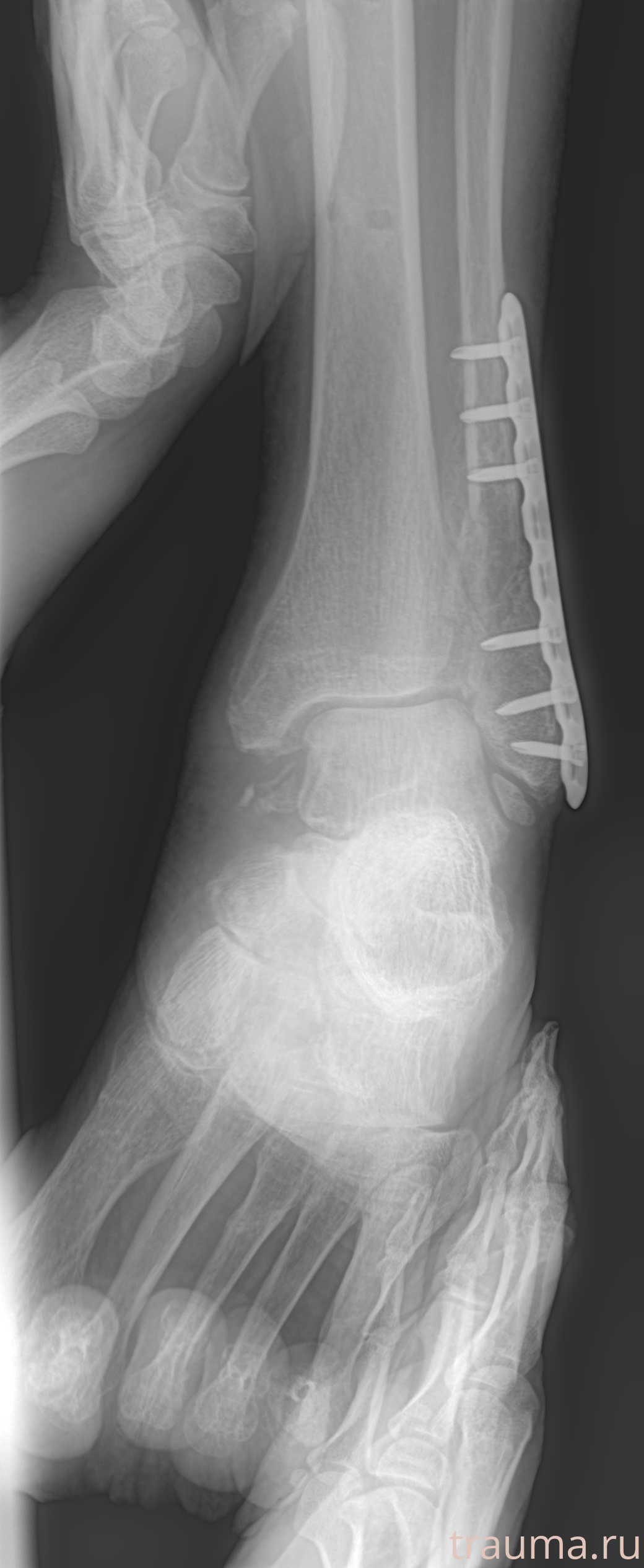 Рентген на дому: по вашему адресу приезжает врач-рентгенолог, травматолог-ортопед с мобильным рентгеновским аппаратом, проводит диагностику травмы или заболевания, делает необходимые рентгенограммы, дает рекомендации по дальнейшему лечению. Получить качественные снимки в домашних условиях возможно благодаря уникальной методике, разработанной МосРентген Центром для института  Склифосовского