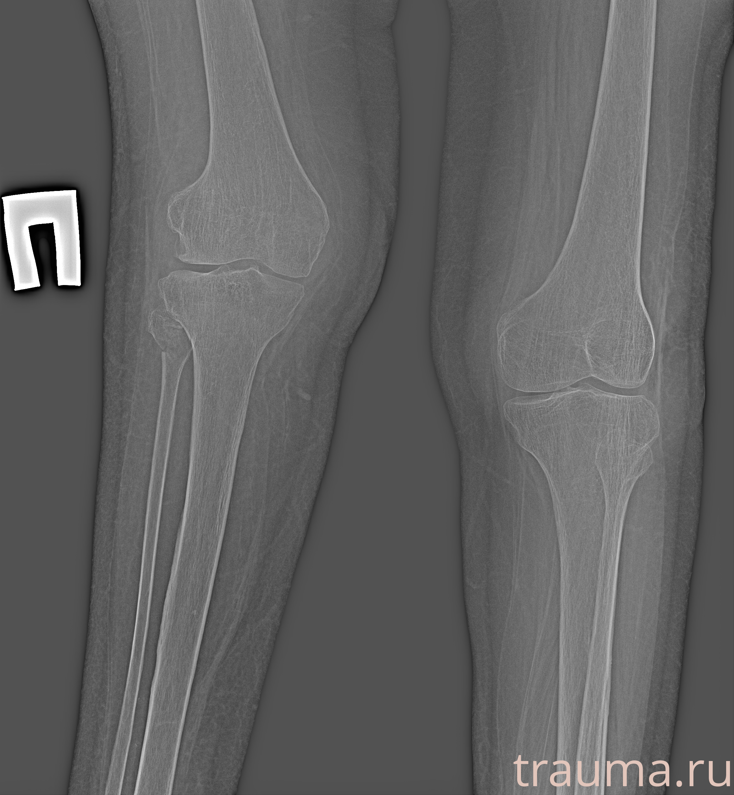 Рентген на дому: по вашему адресу приезжает врач-рентгенолог, травматолог-ортопед с мобильным рентгеновским аппаратом, проводит диагностику травмы или заболевания, делает необходимые рентгенограммы, дает рекомендации по дальнейшему лечению. Получить качественные снимки в домашних условиях возможно благодаря уникальной методике, разработанной МосРентген Центром для института  Склифосовского