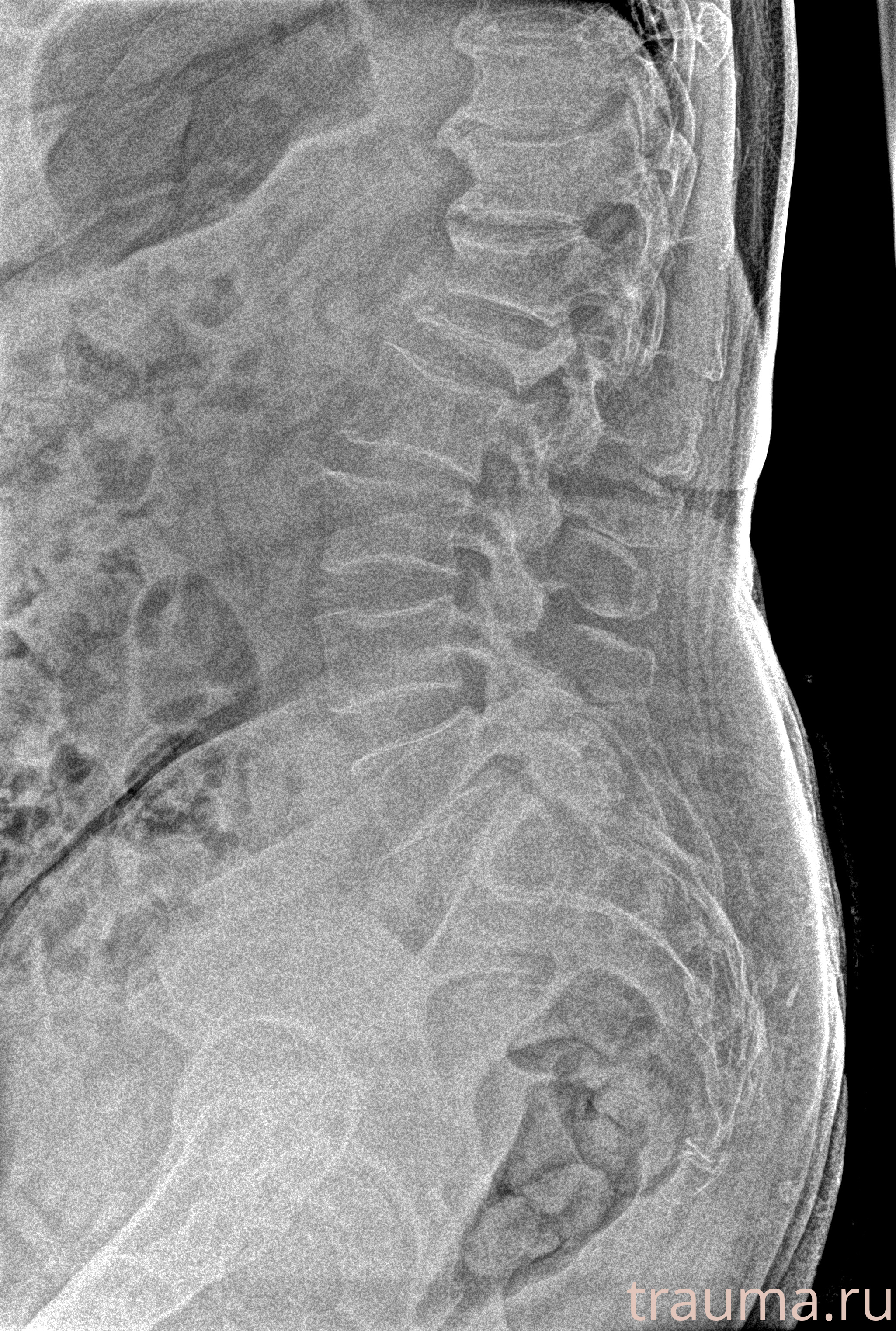 Рентген на дому: по вашему адресу приезжает врач-рентгенолог, травматолог-ортопед с мобильным рентгеновским аппаратом, проводит диагностику травмы или заболевания, делает необходимые рентгенограммы, дает рекомендации по дальнейшему лечению. Получить качественные снимки в домашних условиях возможно благодаря уникальной методике, разработанной МосРентген Центром для института  Склифосовского