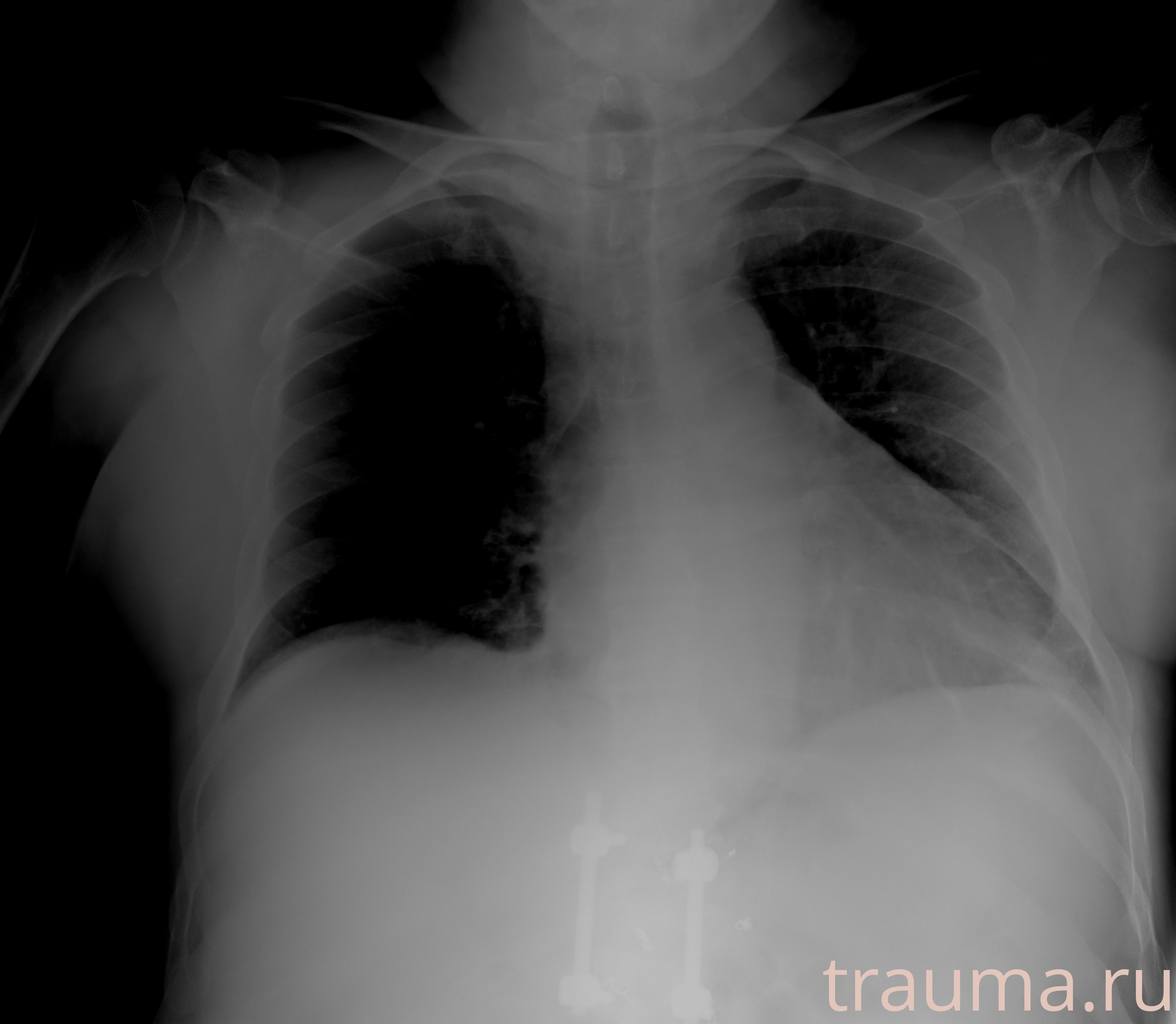 Рентген на дому: по вашему адресу приезжает врач-рентгенолог, травматолог-ортопед с мобильным рентгеновским аппаратом, проводит диагностику травмы или заболевания, делает необходимые рентгенограммы, дает рекомендации по дальнейшему лечению. Получить качественные снимки в домашних условиях возможно благодаря уникальной методике, разработанной МосРентген Центром для института  Склифосовского