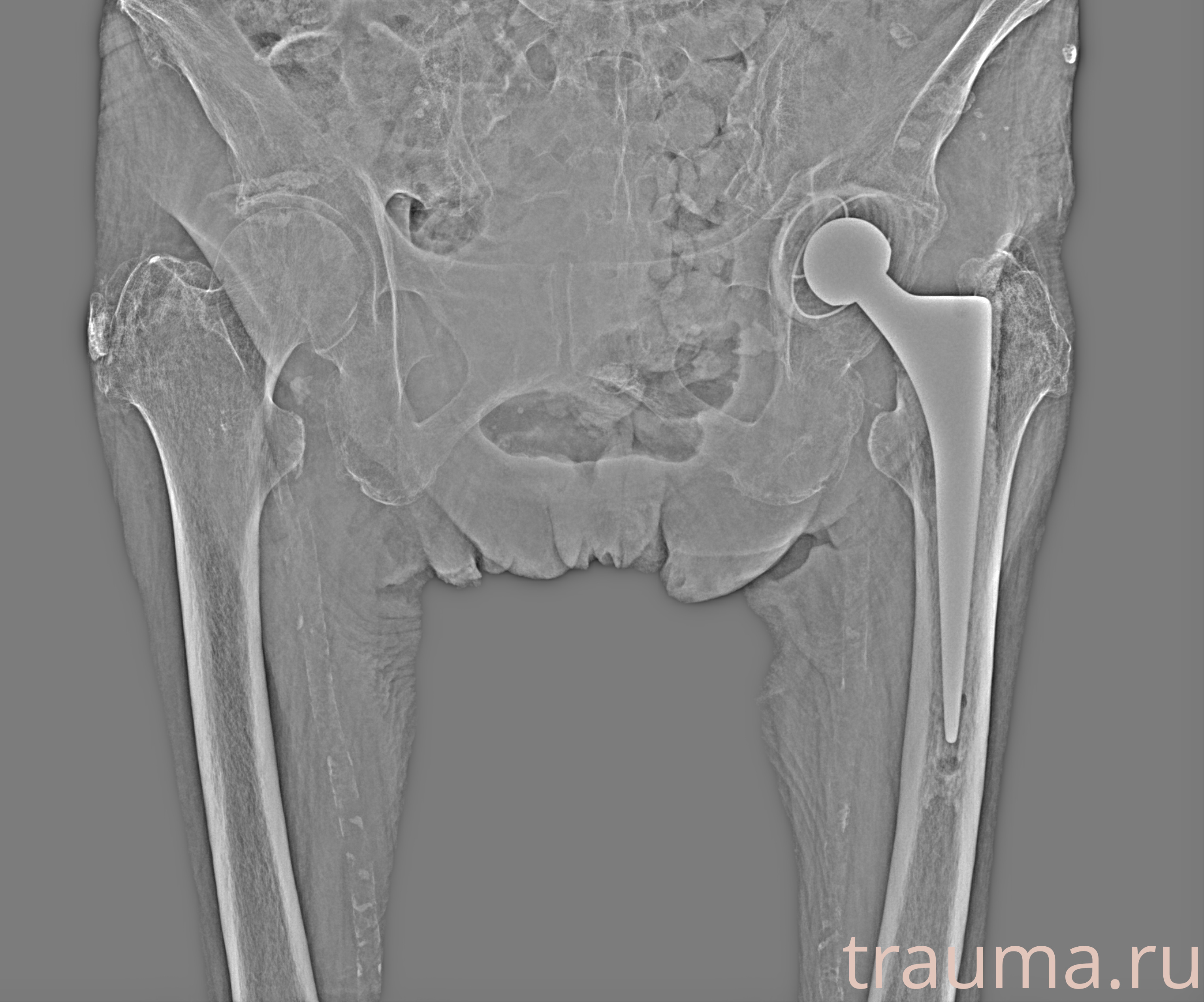 Рентген на дому: по вашему адресу приезжает врач-рентгенолог, травматолог-ортопед с мобильным рентгеновским аппаратом, проводит диагностику травмы или заболевания, делает необходимые рентгенограммы, дает рекомендации по дальнейшему лечению. Получить качественные снимки в домашних условиях возможно благодаря уникальной методике, разработанной МосРентген Центром для института  Склифосовского