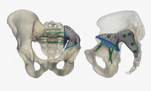Использование 30-технологий в мини-инвазивной хирургии травм костей таза