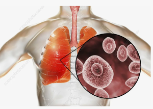 Грибковые поражения легких