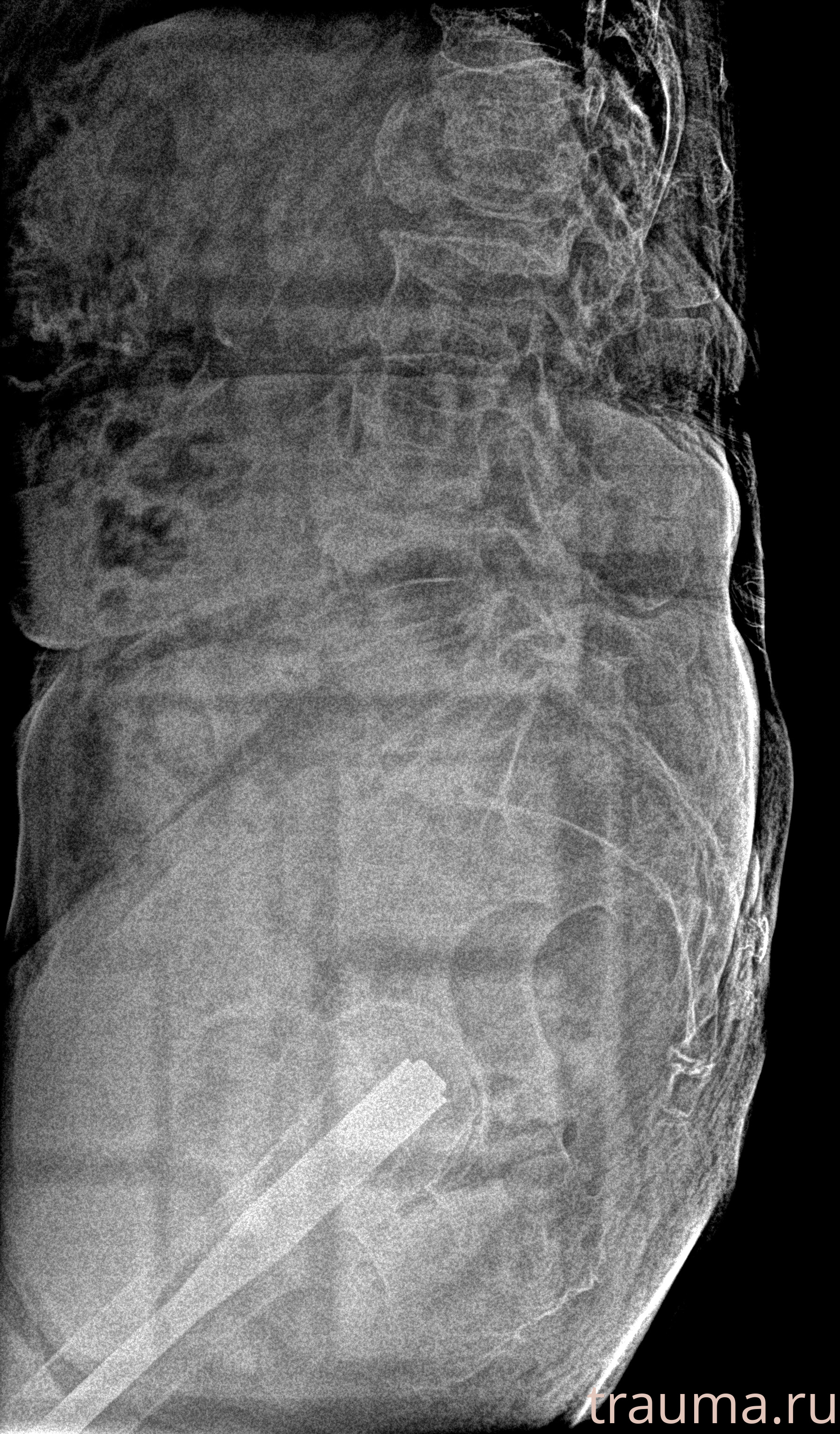 Рентген на дому: по вашему адресу приезжает врач-рентгенолог, травматолог-ортопед с мобильным рентгеновским аппаратом, проводит диагностику травмы или заболевания, делает необходимые рентгенограммы, дает рекомендации по дальнейшему лечению. Получить качественные снимки в домашних условиях возможно благодаря уникальной методике, разработанной МосРентген Центром для института  Склифосовского