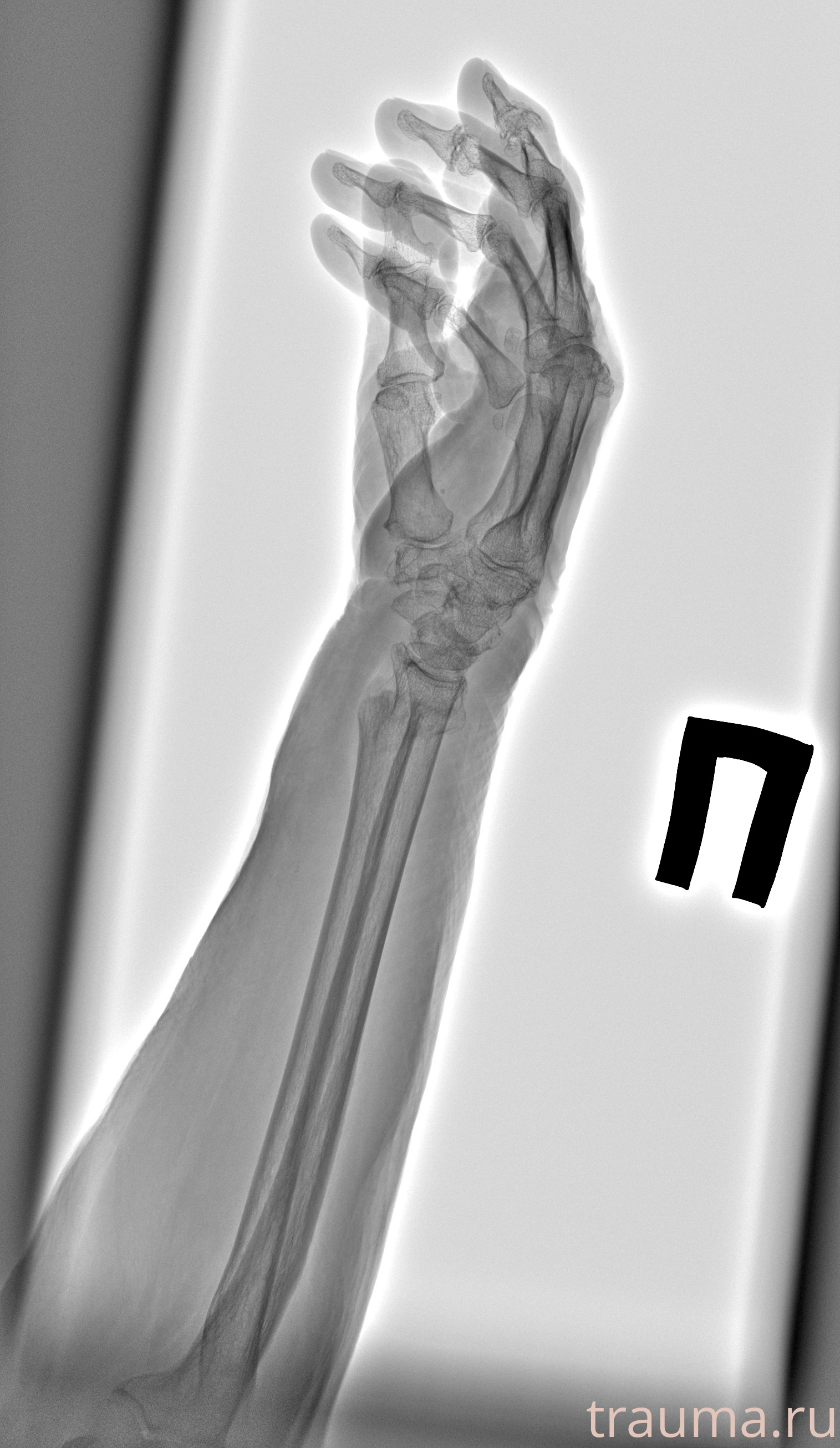 Рентген на дому: по вашему адресу приезжает врач-рентгенолог, травматолог-ортопед с мобильным рентгеновским аппаратом, проводит диагностику травмы или заболевания, делает необходимые рентгенограммы, дает рекомендации по дальнейшему лечению. Получить качественные снимки в домашних условиях возможно благодаря уникальной методике, разработанной МосРентген Центром для института  Склифосовского