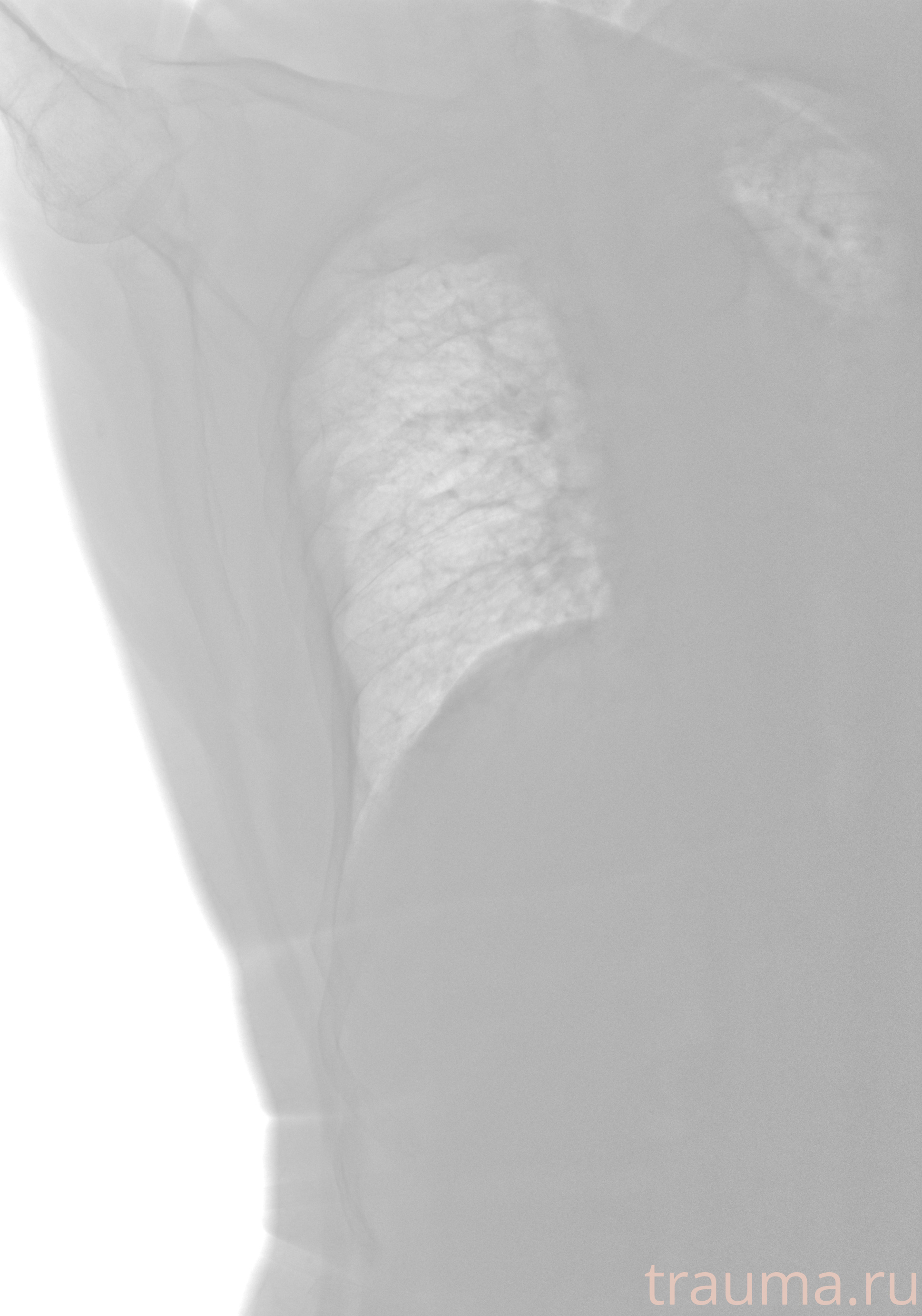 Рентген на дому: по вашему адресу приезжает врач-рентгенолог, травматолог-ортопед с мобильным рентгеновским аппаратом, проводит диагностику травмы или заболевания, делает необходимые рентгенограммы, дает рекомендации по дальнейшему лечению. Получить качественные снимки в домашних условиях возможно благодаря уникальной методике, разработанной МосРентген Центром для института  Склифосовского