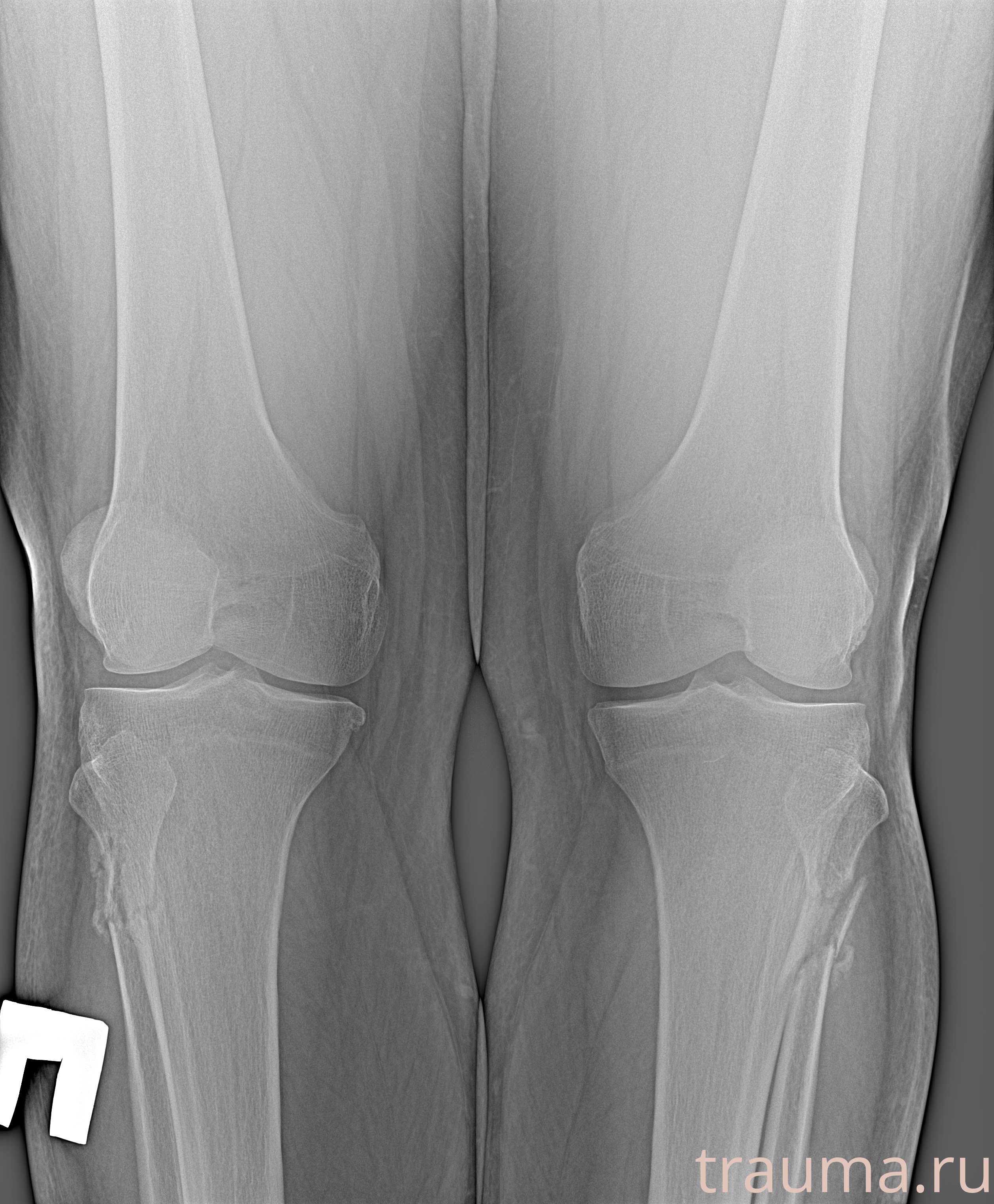 Рентген на дому: по вашему адресу приезжает врач-рентгенолог, травматолог-ортопед с мобильным рентгеновским аппаратом, проводит диагностику травмы или заболевания, делает необходимые рентгенограммы, дает рекомендации по дальнейшему лечению. Получить качественные снимки в домашних условиях возможно благодаря уникальной методике, разработанной МосРентген Центром для института  Склифосовского