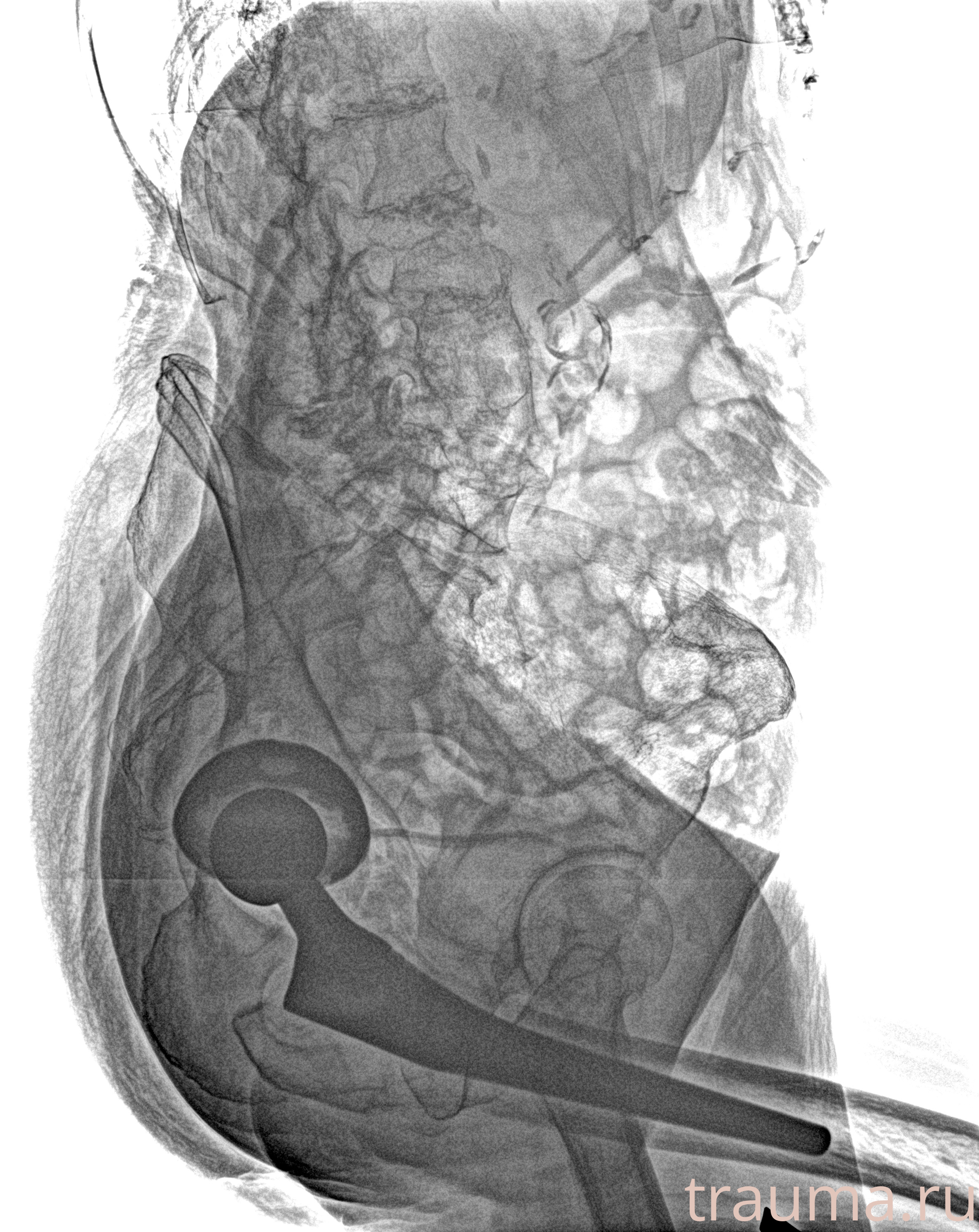 Рентген на дому: по вашему адресу приезжает врач-рентгенолог, травматолог-ортопед с мобильным рентгеновским аппаратом, проводит диагностику травмы или заболевания, делает необходимые рентгенограммы, дает рекомендации по дальнейшему лечению. Получить качественные снимки в домашних условиях возможно благодаря уникальной методике, разработанной МосРентген Центром для института  Склифосовского