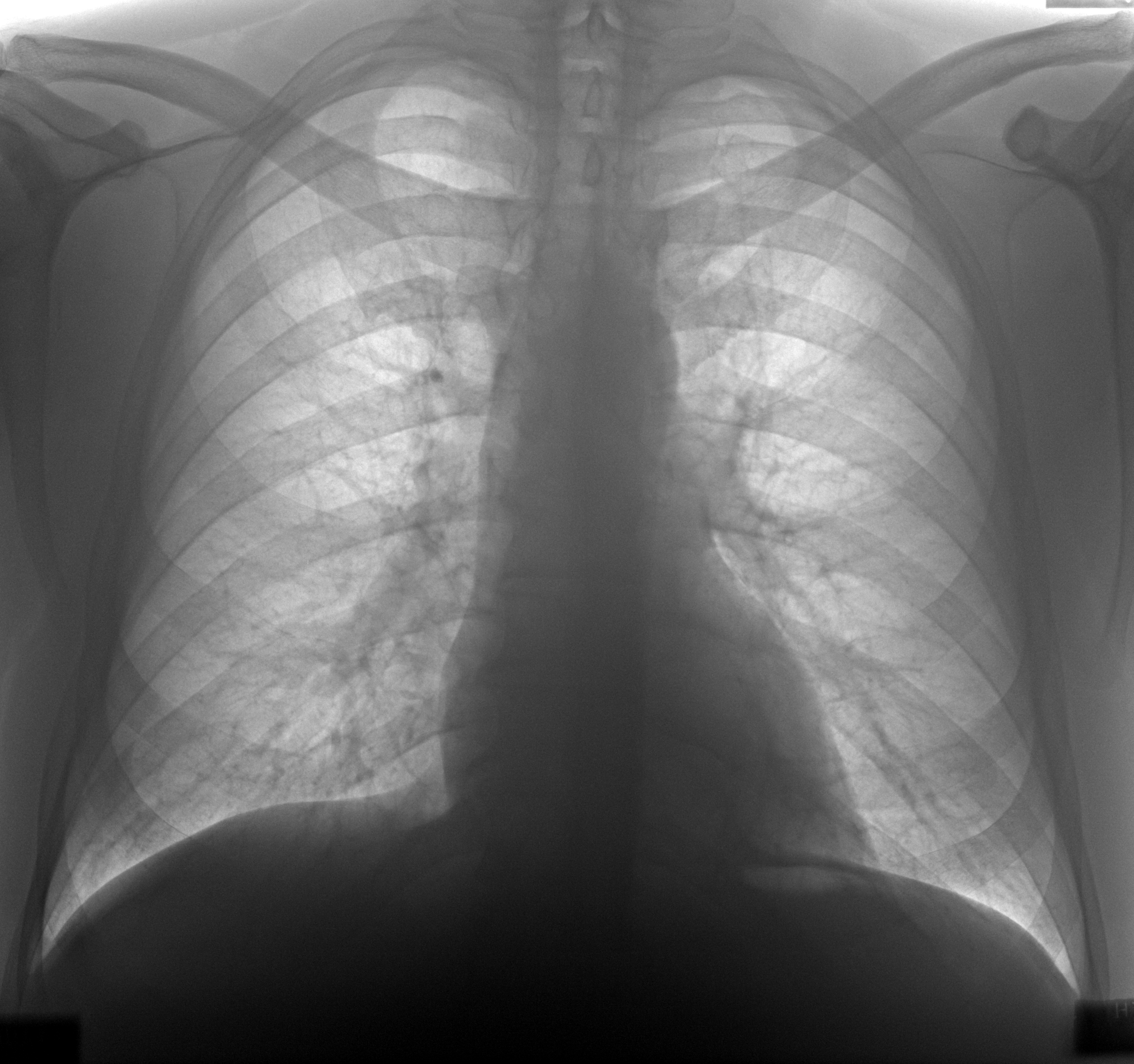 Туберкулез рентген снимки