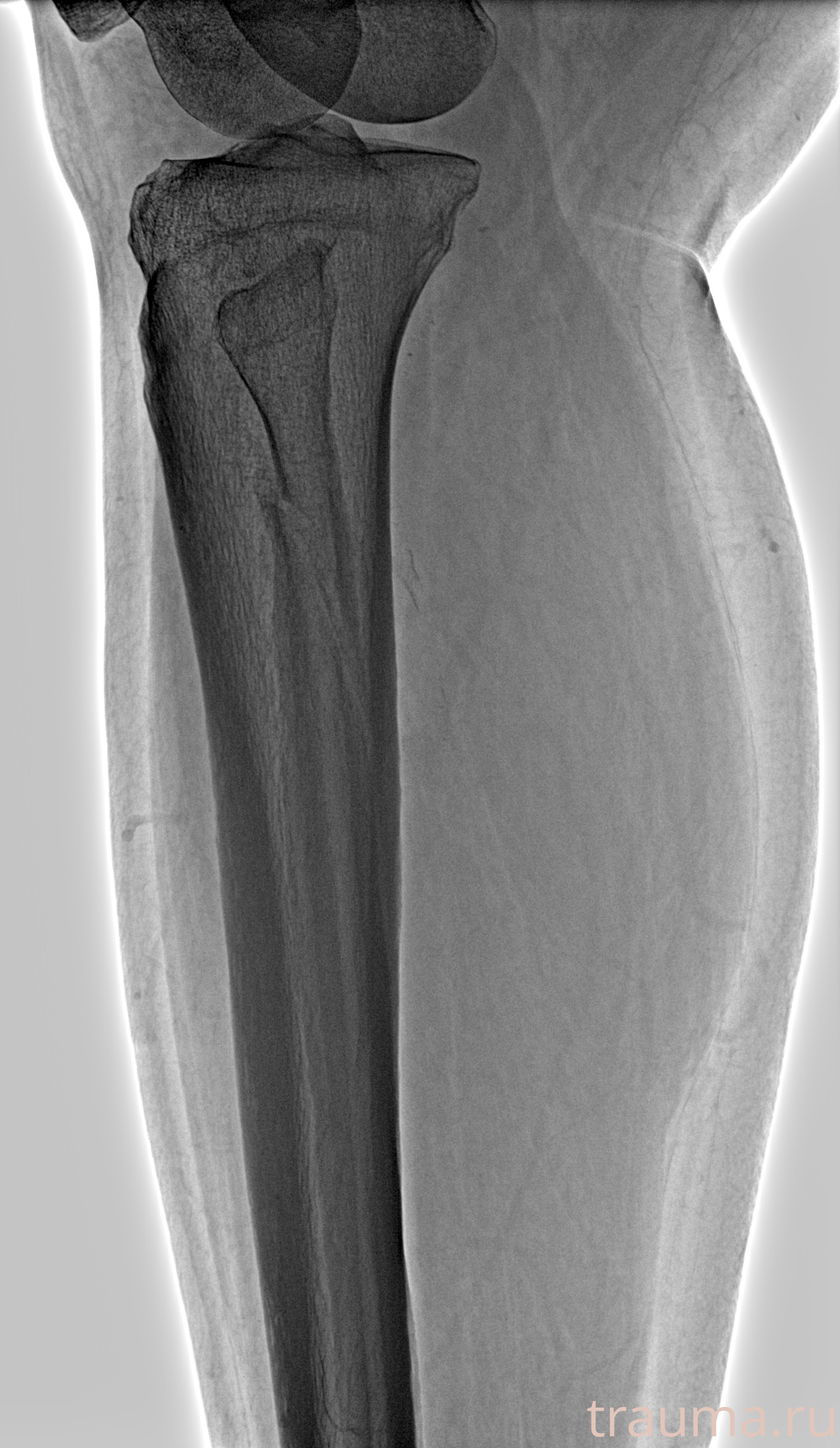 Рентген на дому: по вашему адресу приезжает врач-рентгенолог, травматолог-ортопед с мобильным рентгеновским аппаратом, проводит диагностику травмы или заболевания, делает необходимые рентгенограммы, дает рекомендации по дальнейшему лечению. Получить качественные снимки в домашних условиях возможно благодаря уникальной методике, разработанной МосРентген Центром для института  Склифосовского