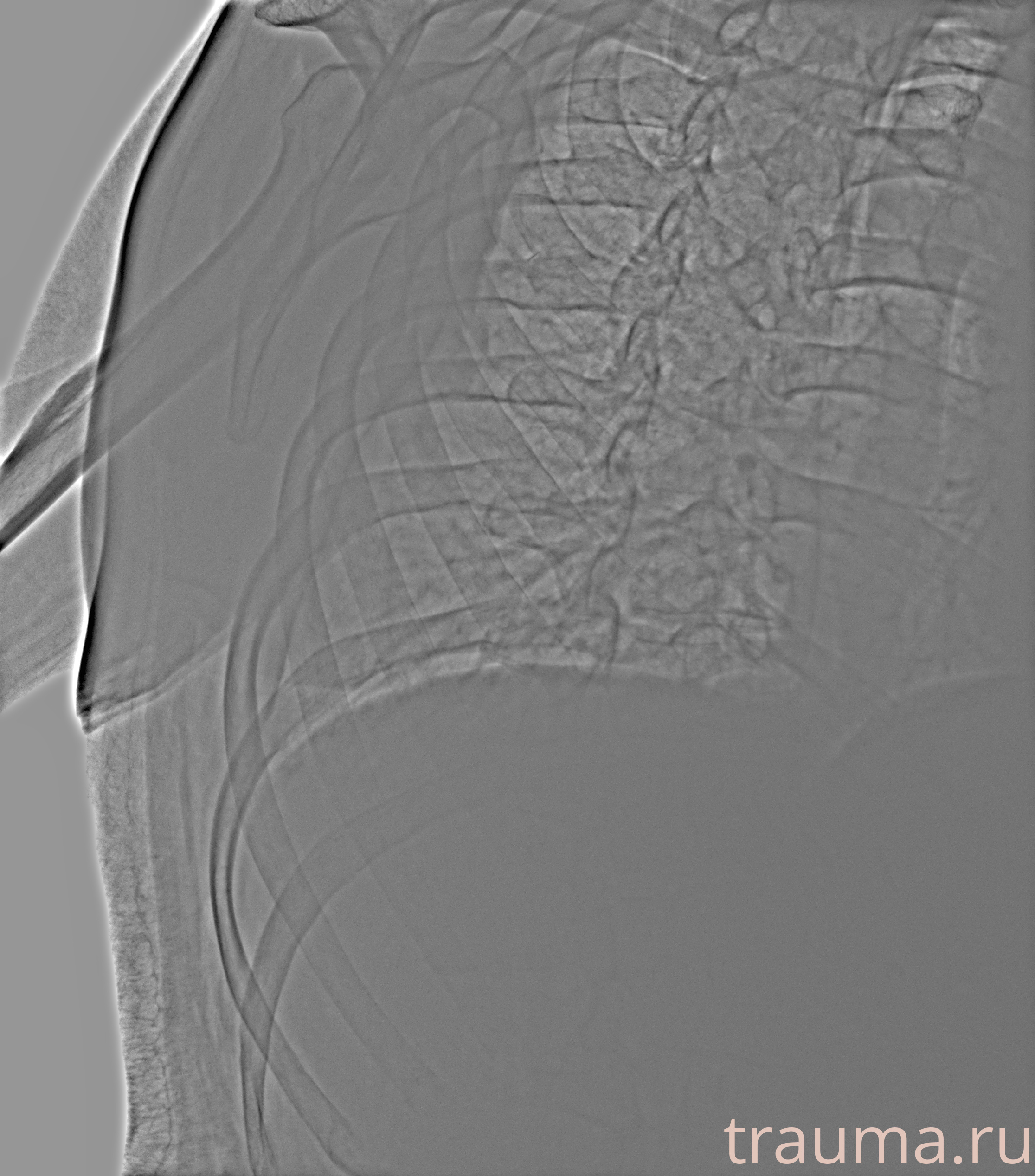 Рентген на дому: по вашему адресу приезжает врач-рентгенолог, травматолог-ортопед с мобильным рентгеновским аппаратом, проводит диагностику травмы или заболевания, делает необходимые рентгенограммы, дает рекомендации по дальнейшему лечению. Получить качественные снимки в домашних условиях возможно благодаря уникальной методике, разработанной МосРентген Центром для института  Склифосовского