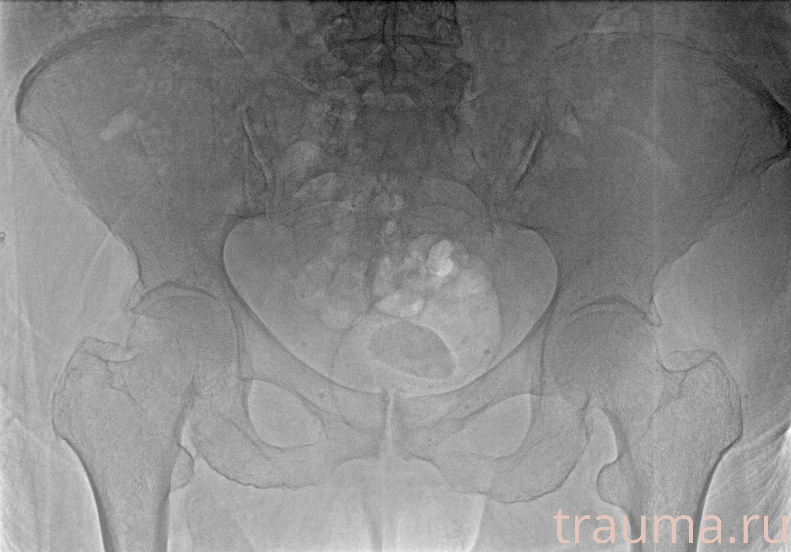 Рентген на дому: по вашему адресу приезжает врач-рентгенолог, травматолог-ортопед с мобильным рентгеновским аппаратом, проводит диагностику травмы или заболевания, делает необходимые рентгенограммы, дает рекомендации по дальнейшему лечению. Получить качественные снимки в домашних условиях возможно благодаря уникальной методике, разработанной МосРентген Центром для института  Склифосовского