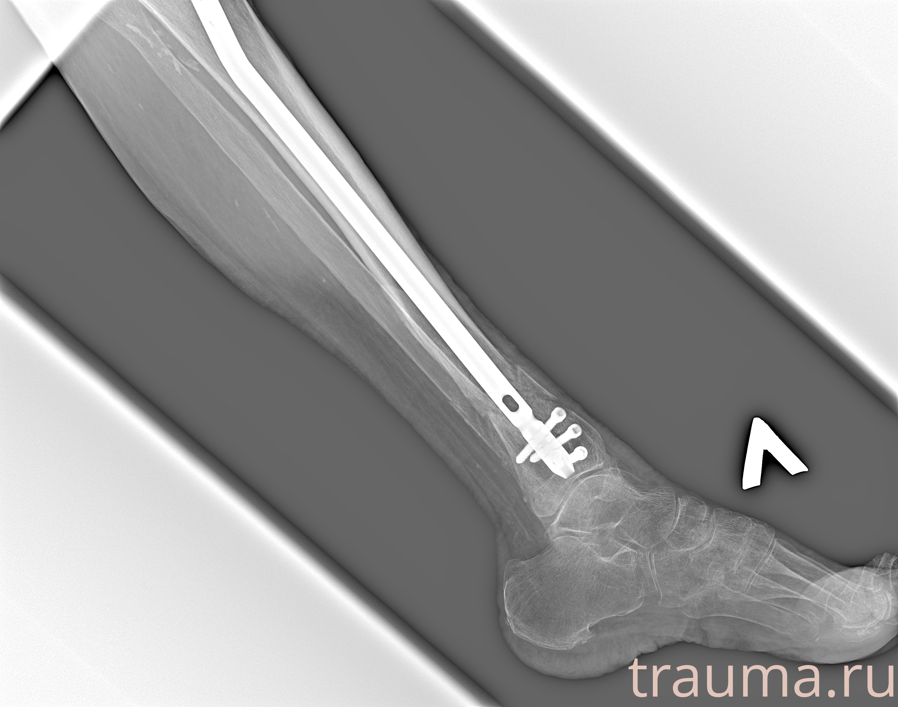 Рентген на дому: по вашему адресу приезжает врач-рентгенолог, травматолог-ортопед с мобильным рентгеновским аппаратом, проводит диагностику травмы или заболевания, делает необходимые рентгенограммы, дает рекомендации по дальнейшему лечению. Получить качественные снимки в домашних условиях возможно благодаря уникальной методике, разработанной МосРентген Центром для института  Склифосовского