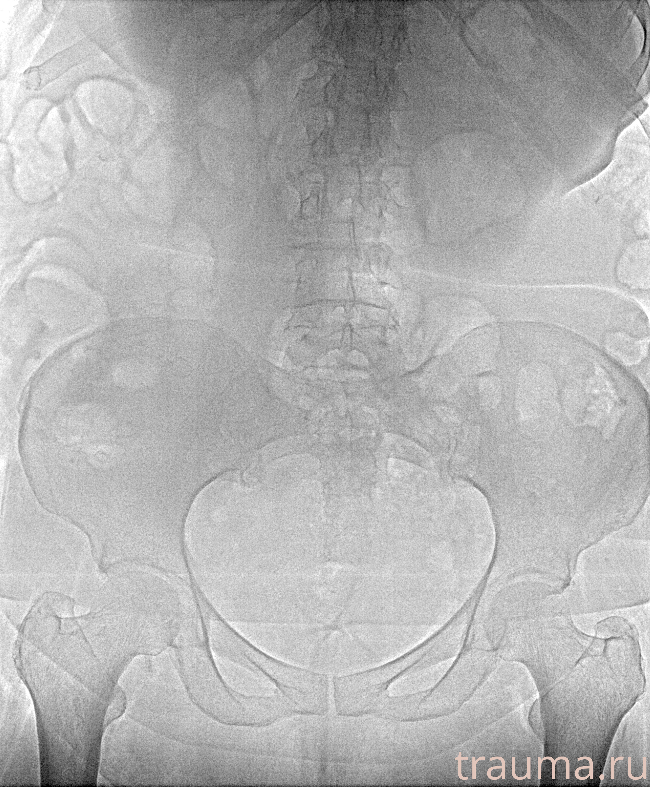 Рентген на дому: по вашему адресу приезжает врач-рентгенолог, травматолог-ортопед с мобильным рентгеновским аппаратом, проводит диагностику травмы или заболевания, делает необходимые рентгенограммы, дает рекомендации по дальнейшему лечению. Получить качественные снимки в домашних условиях возможно благодаря уникальной методике, разработанной МосРентген Центром для института  Склифосовского