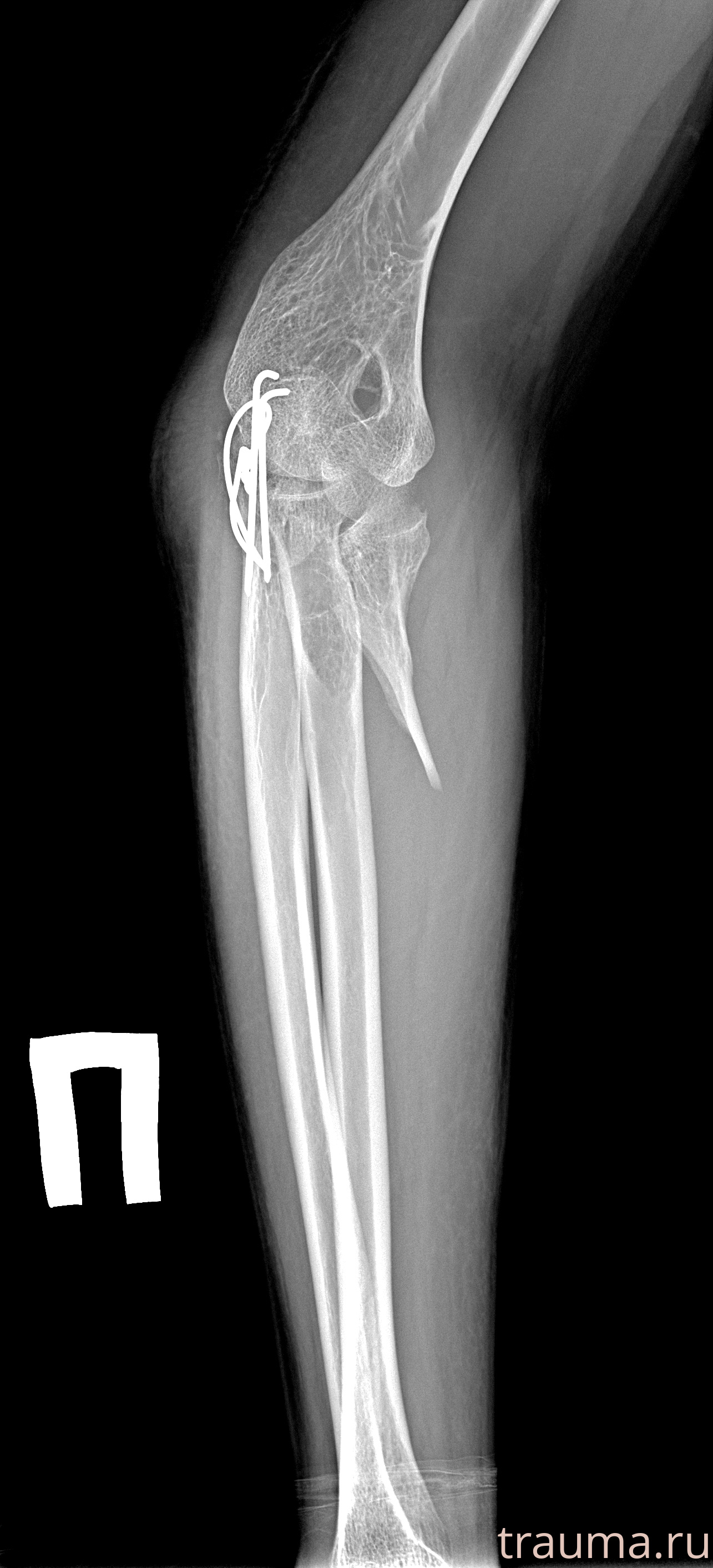 Рентген на дому: по вашему адресу приезжает врач-рентгенолог, травматолог-ортопед с мобильным рентгеновским аппаратом, проводит диагностику травмы или заболевания, делает необходимые рентгенограммы, дает рекомендации по дальнейшему лечению. Получить качественные снимки в домашних условиях возможно благодаря уникальной методике, разработанной МосРентген Центром для института  Склифосовского