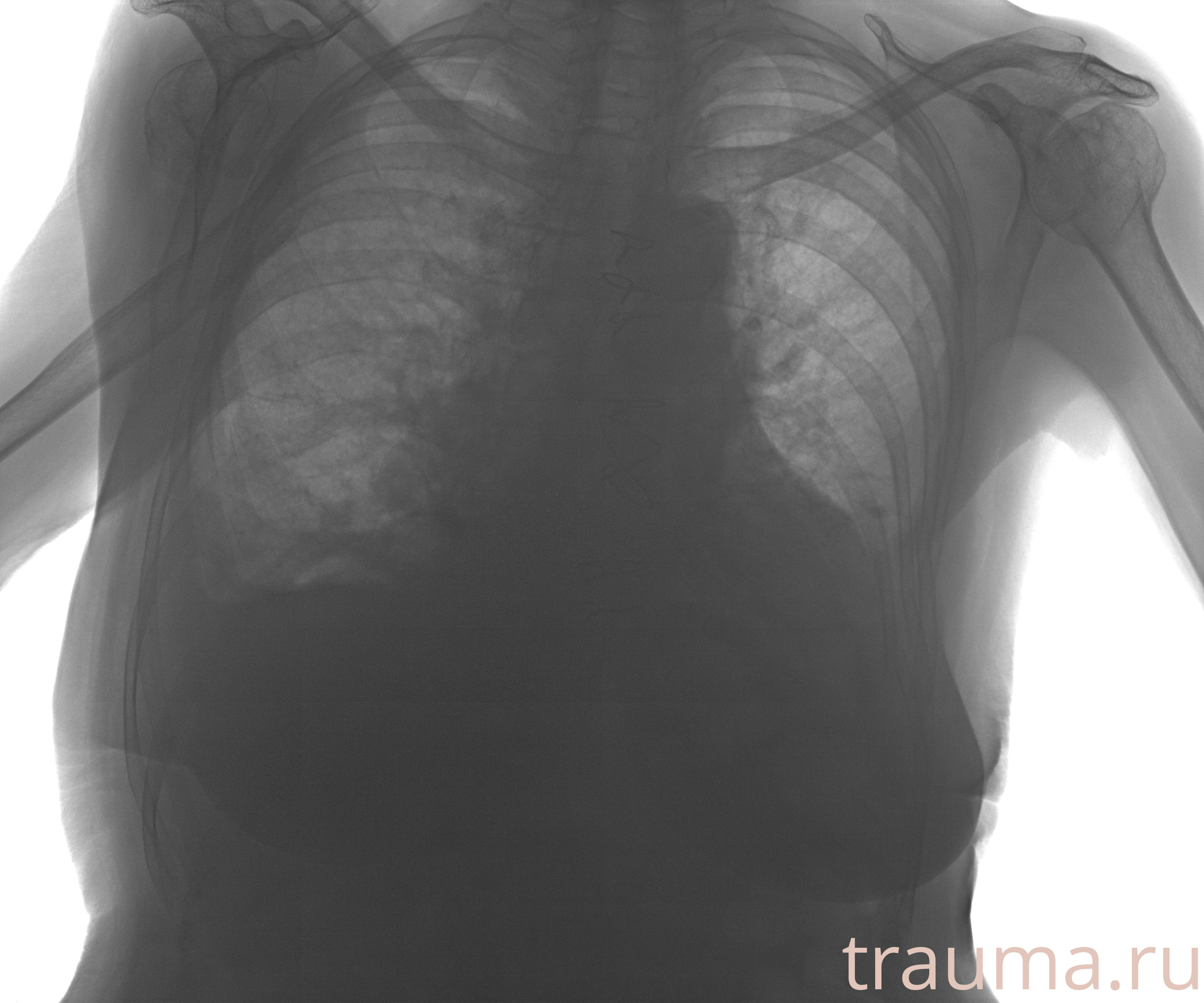 Рентген на дому: по вашему адресу приезжает врач-рентгенолог, травматолог-ортопед с мобильным рентгеновским аппаратом, проводит диагностику травмы или заболевания, делает необходимые рентгенограммы, дает рекомендации по дальнейшему лечению. Получить качественные снимки в домашних условиях возможно благодаря уникальной методике, разработанной МосРентген Центром для института  Склифосовского