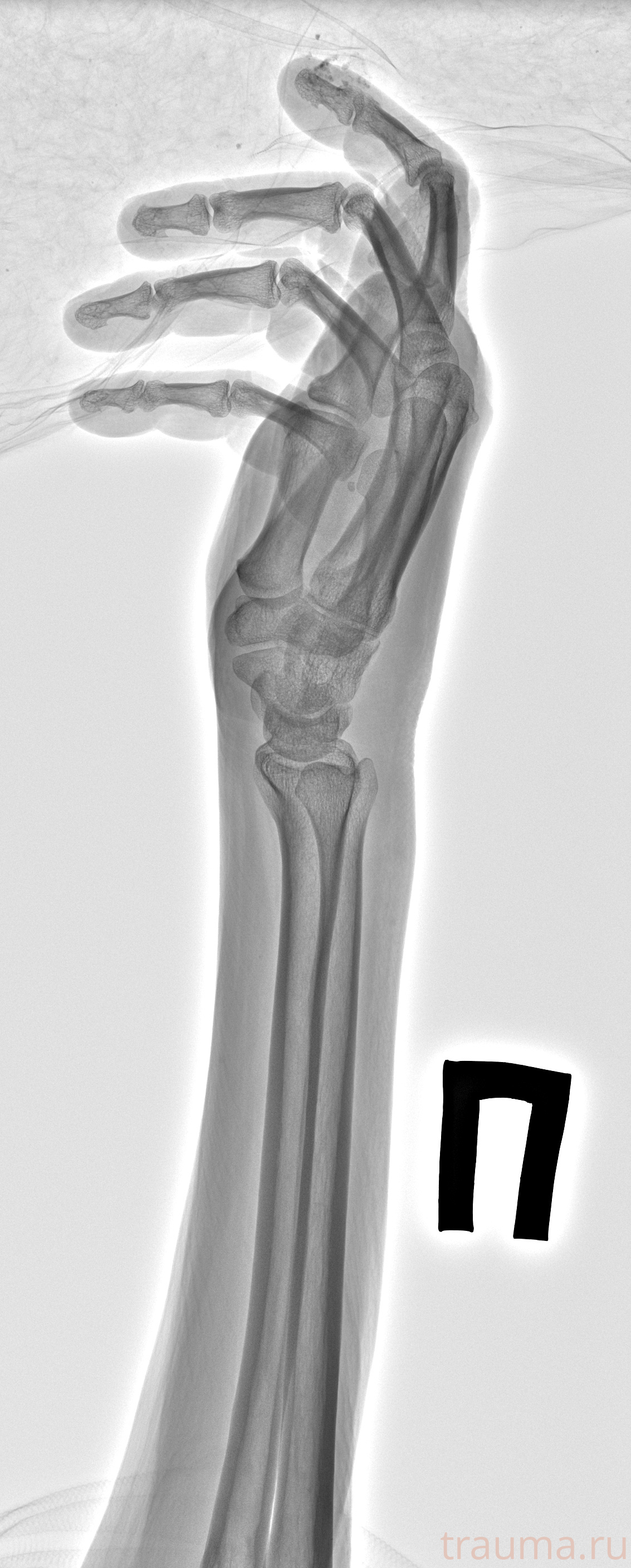 Рентген на дому: по вашему адресу приезжает врач-рентгенолог, травматолог-ортопед с мобильным рентгеновским аппаратом, проводит диагностику травмы или заболевания, делает необходимые рентгенограммы, дает рекомендации по дальнейшему лечению. Получить качественные снимки в домашних условиях возможно благодаря уникальной методике, разработанной МосРентген Центром для института  Склифосовского