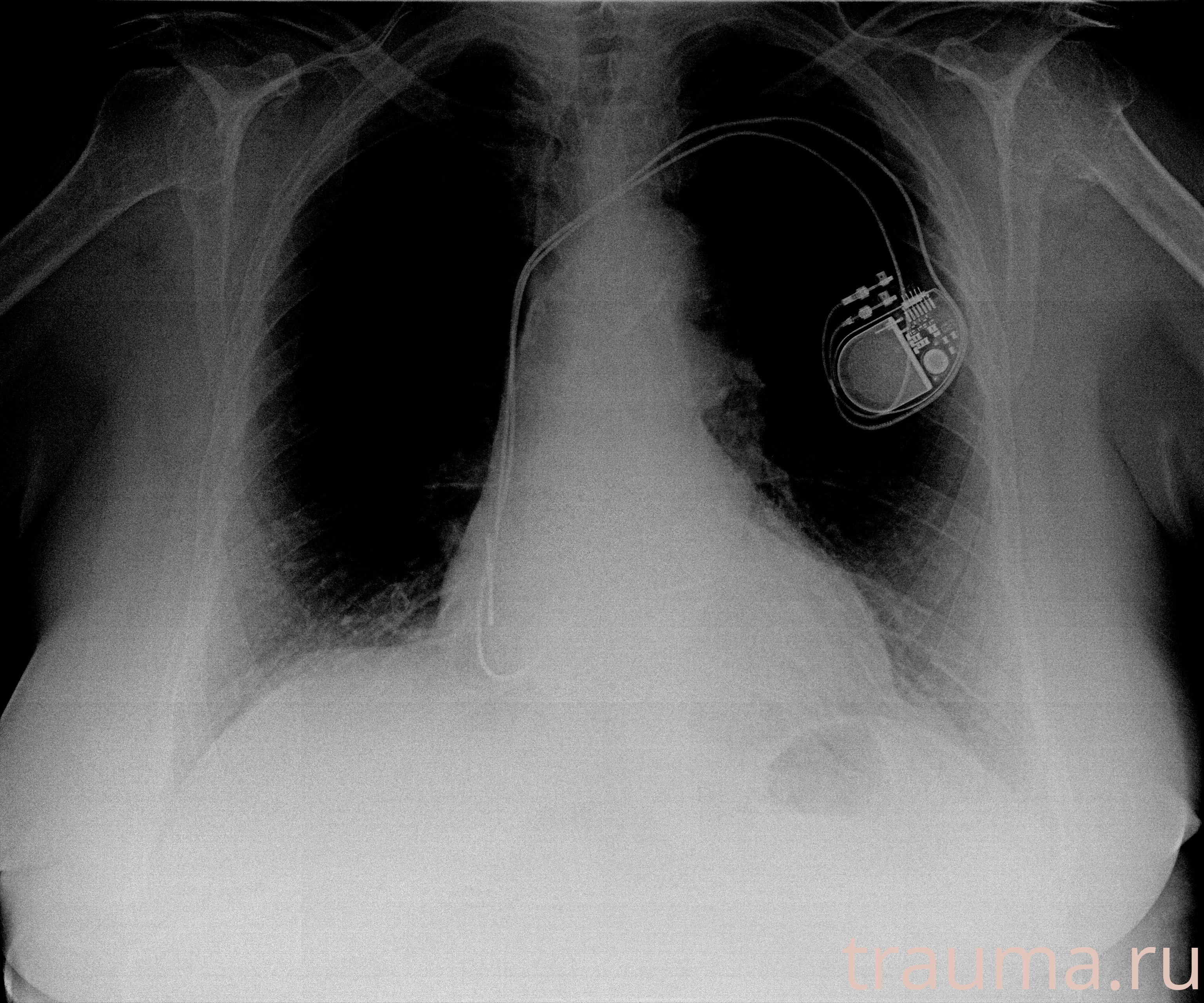 Рентген на дому: по вашему адресу приезжает врач-рентгенолог, травматолог-ортопед с мобильным рентгеновским аппаратом, проводит диагностику травмы или заболевания, делает необходимые рентгенограммы, дает рекомендации по дальнейшему лечению. Получить качественные снимки в домашних условиях возможно благодаря уникальной методике, разработанной МосРентген Центром для института  Склифосовского