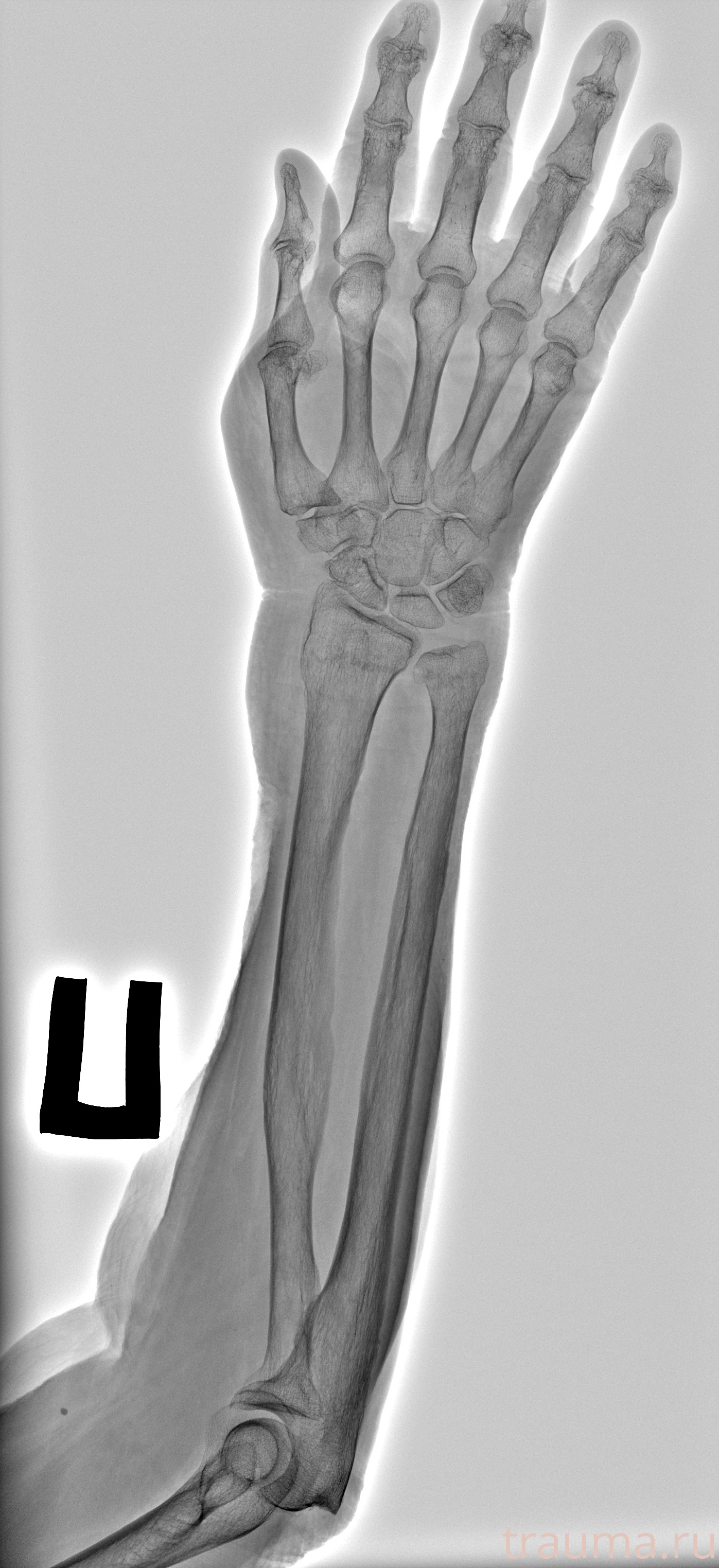 Рентген на дому: по вашему адресу приезжает врач-рентгенолог, травматолог-ортопед с мобильным рентгеновским аппаратом, проводит диагностику травмы или заболевания, делает необходимые рентгенограммы, дает рекомендации по дальнейшему лечению. Получить качественные снимки в домашних условиях возможно благодаря уникальной методике, разработанной МосРентген Центром для института  Склифосовского