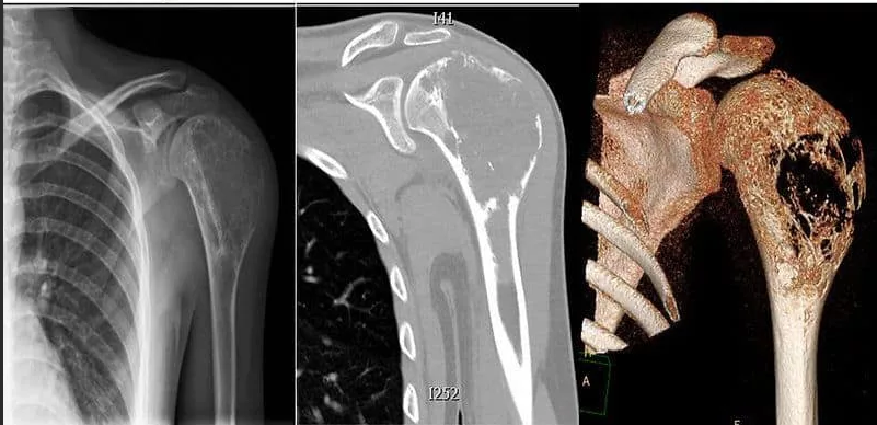 Рак костей фото больных
