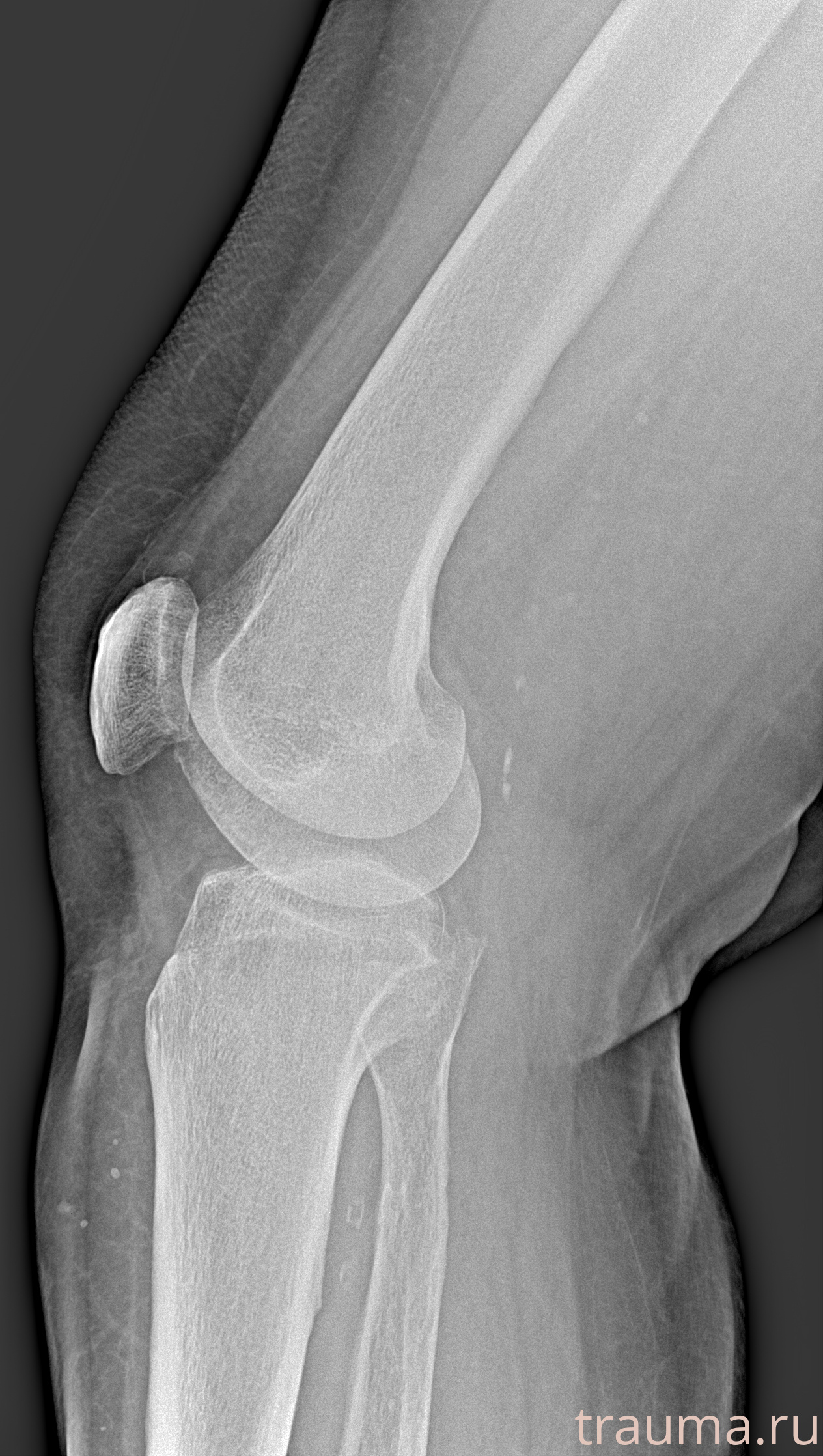 Рентген на дому: по вашему адресу приезжает врач-рентгенолог, травматолог-ортопед с мобильным рентгеновским аппаратом, проводит диагностику травмы или заболевания, делает необходимые рентгенограммы, дает рекомендации по дальнейшему лечению. Получить качественные снимки в домашних условиях возможно благодаря уникальной методике, разработанной МосРентген Центром для института  Склифосовского