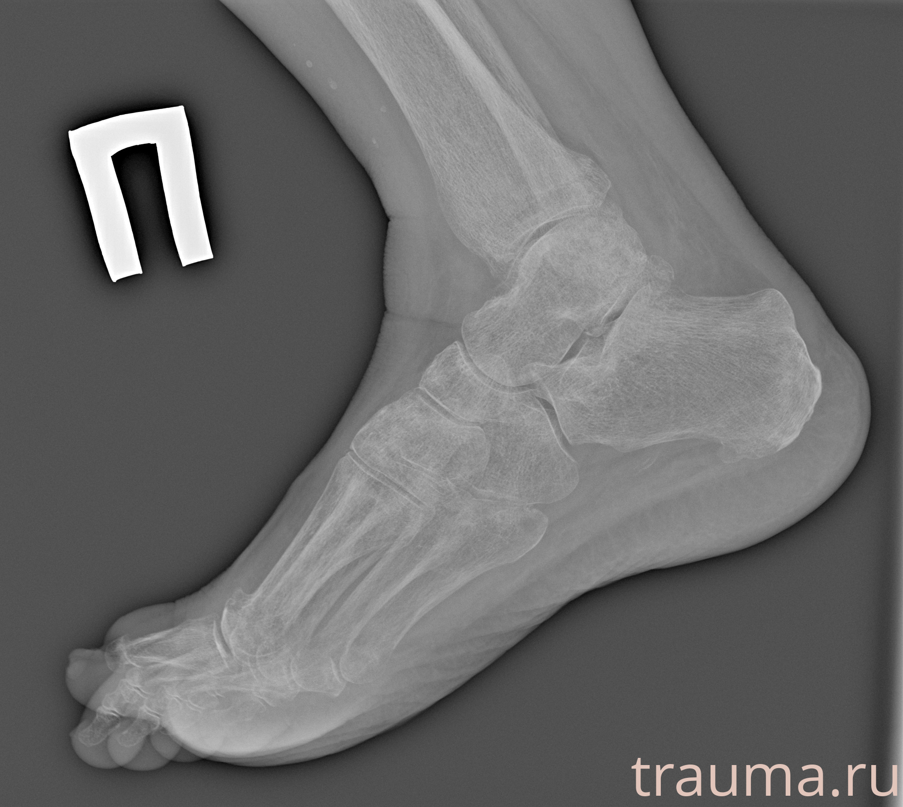 Рентген на дому: по вашему адресу приезжает врач-рентгенолог, травматолог-ортопед с мобильным рентгеновским аппаратом, проводит диагностику травмы или заболевания, делает необходимые рентгенограммы, дает рекомендации по дальнейшему лечению. Получить качественные снимки в домашних условиях возможно благодаря уникальной методике, разработанной МосРентген Центром для института  Склифосовского