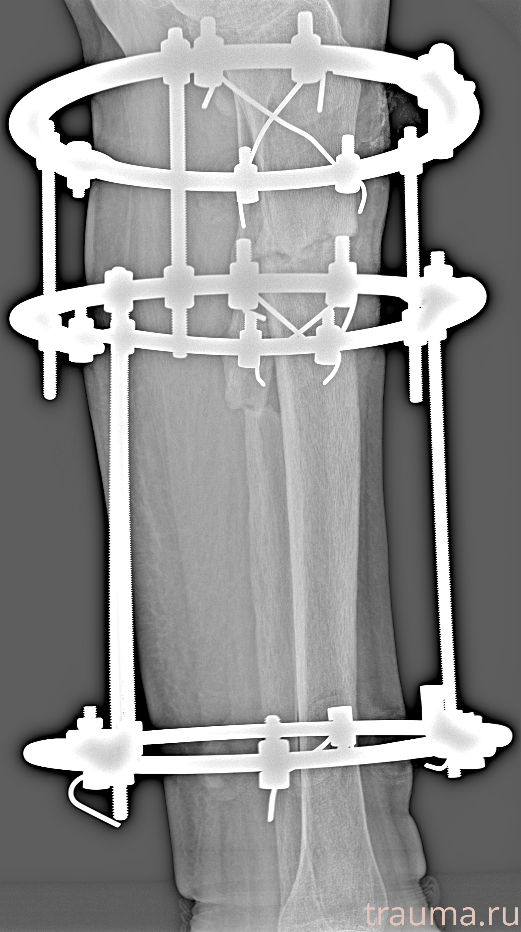 Рентген на дому: по вашему адресу приезжает врач-рентгенолог, травматолог-ортопед с мобильным рентгеновским аппаратом, проводит диагностику травмы или заболевания, делает необходимые рентгенограммы, дает рекомендации по дальнейшему лечению. Получить качественные снимки в домашних условиях возможно благодаря уникальной методике, разработанной МосРентген Центром для института  Склифосовского