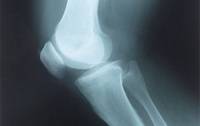 рентген, колено, сустав