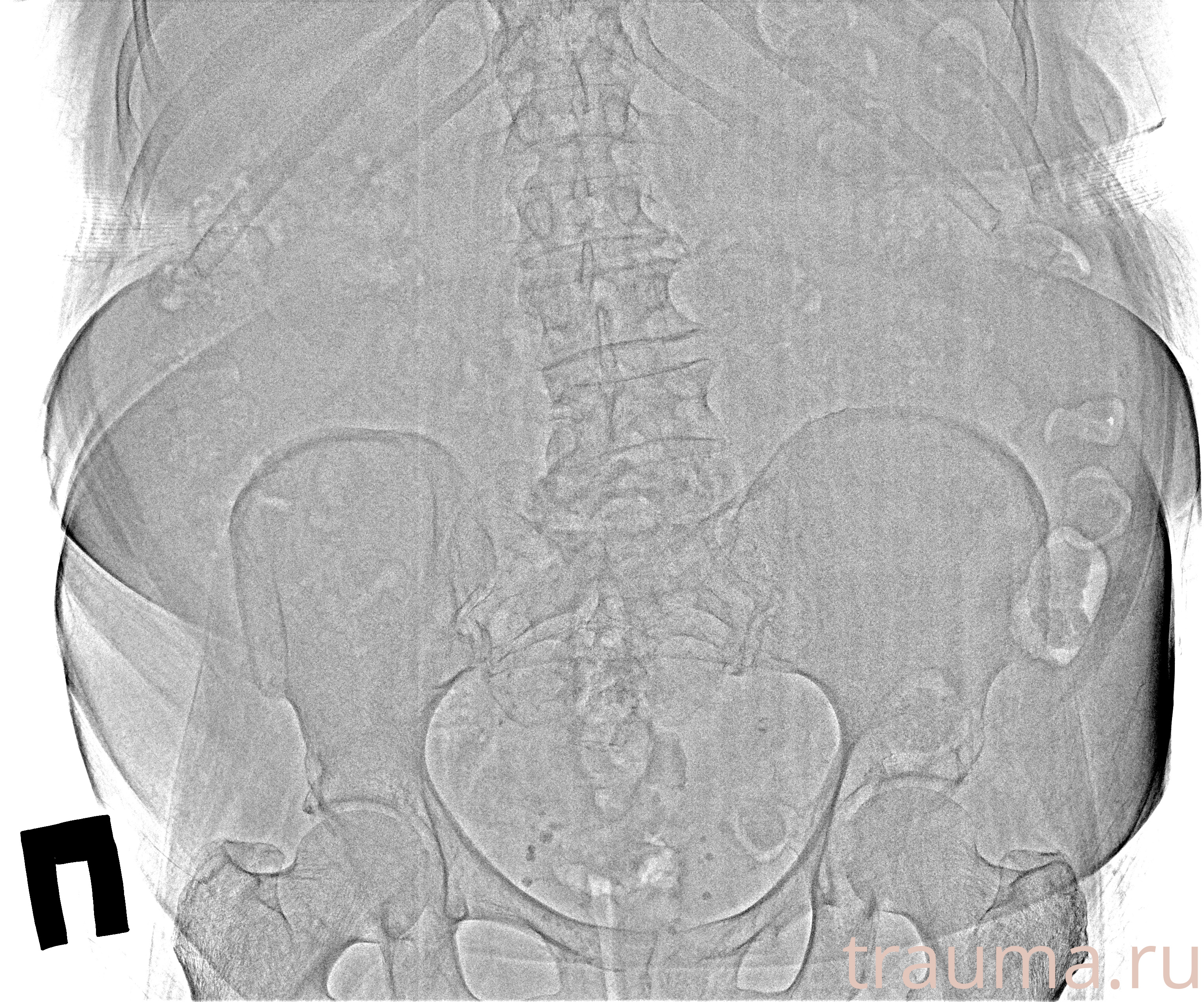 Рентген на дому: по вашему адресу приезжает врач-рентгенолог, травматолог-ортопед с мобильным рентгеновским аппаратом, проводит диагностику травмы или заболевания, делает необходимые рентгенограммы, дает рекомендации по дальнейшему лечению. Получить качественные снимки в домашних условиях возможно благодаря уникальной методике, разработанной МосРентген Центром для института  Склифосовского