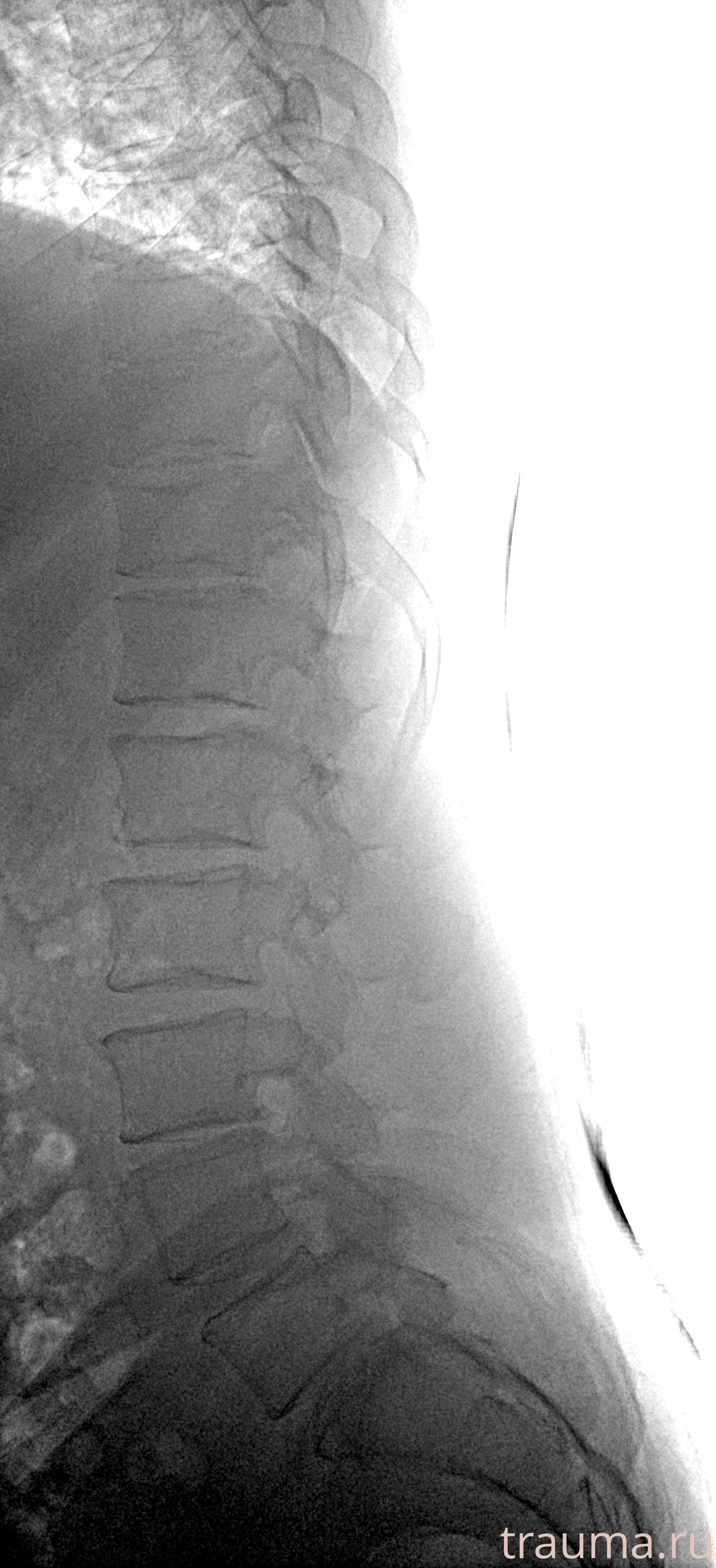 Рентген на дому: по вашему адресу приезжает врач-рентгенолог, травматолог-ортопед с мобильным рентгеновским аппаратом, проводит диагностику травмы или заболевания, делает необходимые рентгенограммы, дает рекомендации по дальнейшему лечению. Получить качественные снимки в домашних условиях возможно благодаря уникальной методике, разработанной МосРентген Центром для института  Склифосовского