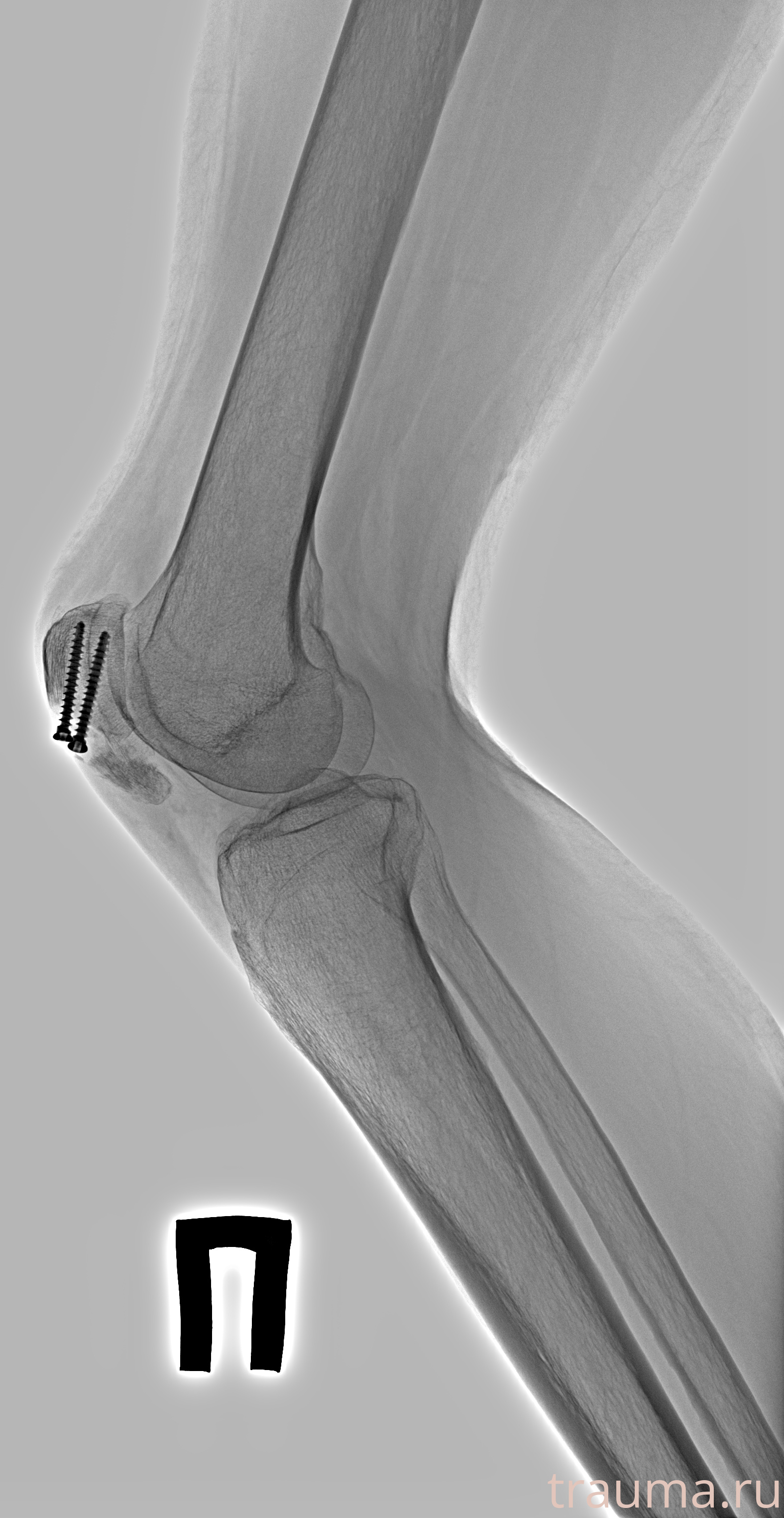 Рентген на дому: по вашему адресу приезжает врач-рентгенолог, травматолог-ортопед с мобильным рентгеновским аппаратом, проводит диагностику травмы или заболевания, делает необходимые рентгенограммы, дает рекомендации по дальнейшему лечению. Получить качественные снимки в домашних условиях возможно благодаря уникальной методике, разработанной МосРентген Центром для института  Склифосовского