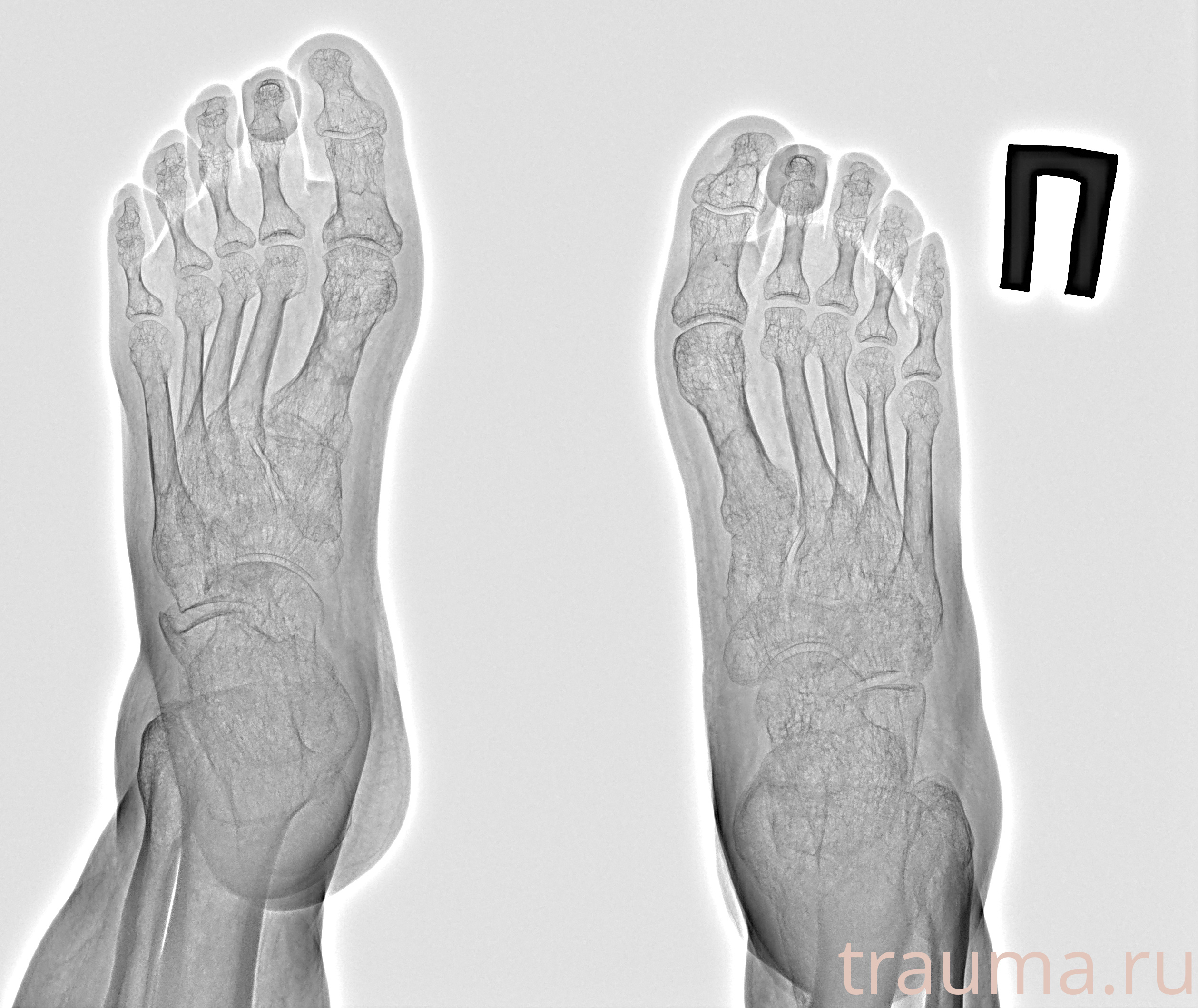 Рентген на дому: по вашему адресу приезжает врач-рентгенолог, травматолог-ортопед с мобильным рентгеновским аппаратом, проводит диагностику травмы или заболевания, делает необходимые рентгенограммы, дает рекомендации по дальнейшему лечению. Получить качественные снимки в домашних условиях возможно благодаря уникальной методике, разработанной МосРентген Центром для института  Склифосовского