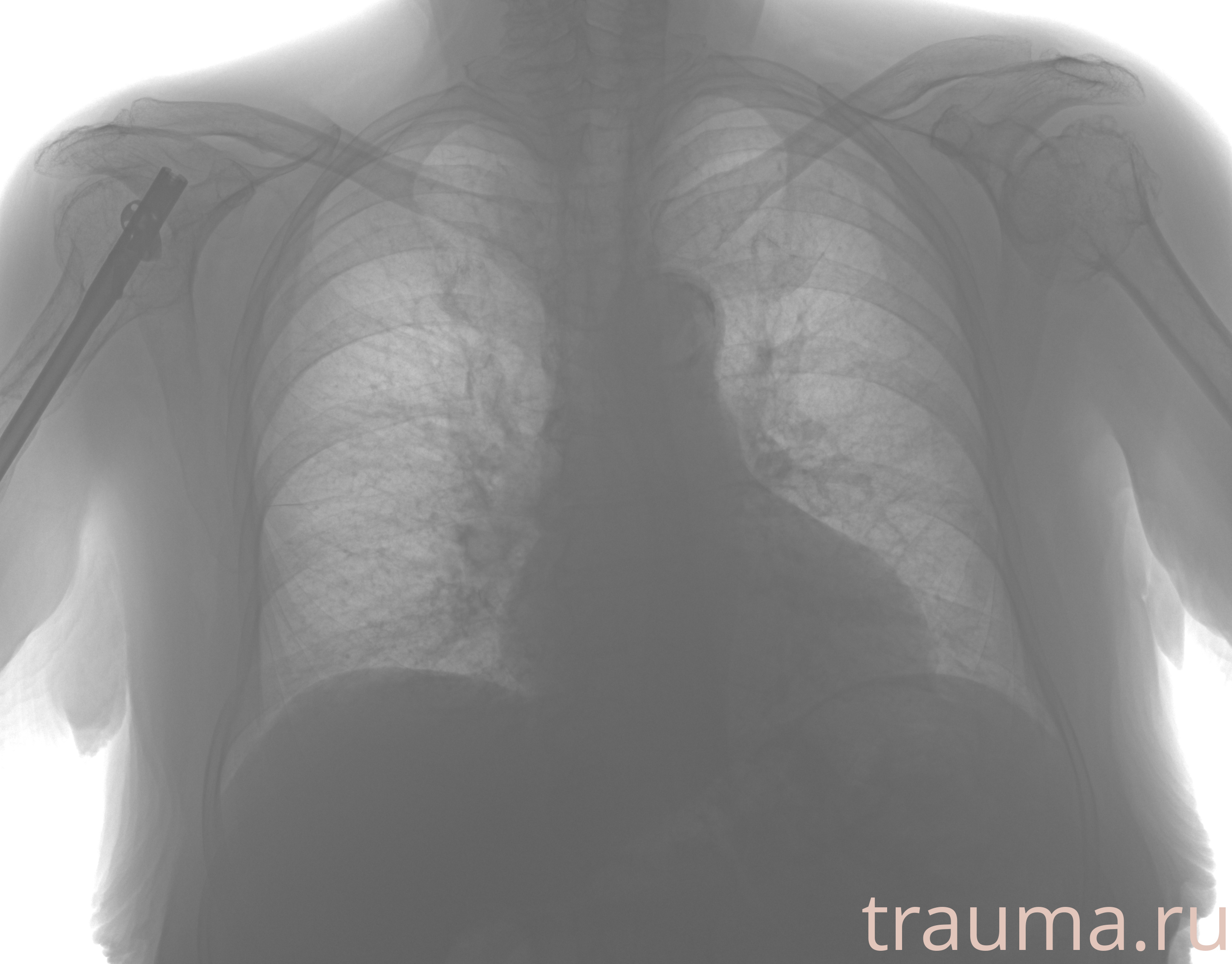 Рентген на дому: по вашему адресу приезжает врач-рентгенолог, травматолог-ортопед с мобильным рентгеновским аппаратом, проводит диагностику травмы или заболевания, делает необходимые рентгенограммы, дает рекомендации по дальнейшему лечению. Получить качественные снимки в домашних условиях возможно благодаря уникальной методике, разработанной МосРентген Центром для института  Склифосовского