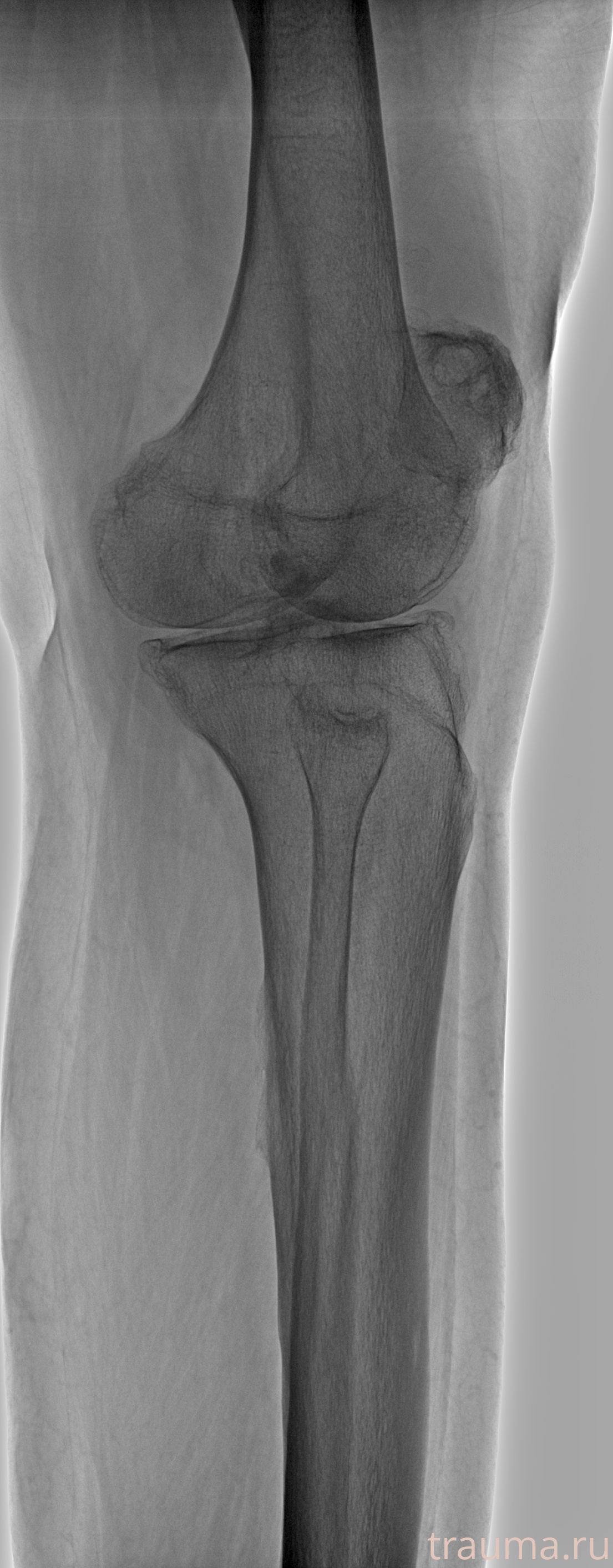 Рентген на дому: по вашему адресу приезжает врач-рентгенолог, травматолог-ортопед с мобильным рентгеновским аппаратом, проводит диагностику травмы или заболевания, делает необходимые рентгенограммы, дает рекомендации по дальнейшему лечению. Получить качественные снимки в домашних условиях возможно благодаря уникальной методике, разработанной МосРентген Центром для института  Склифосовского