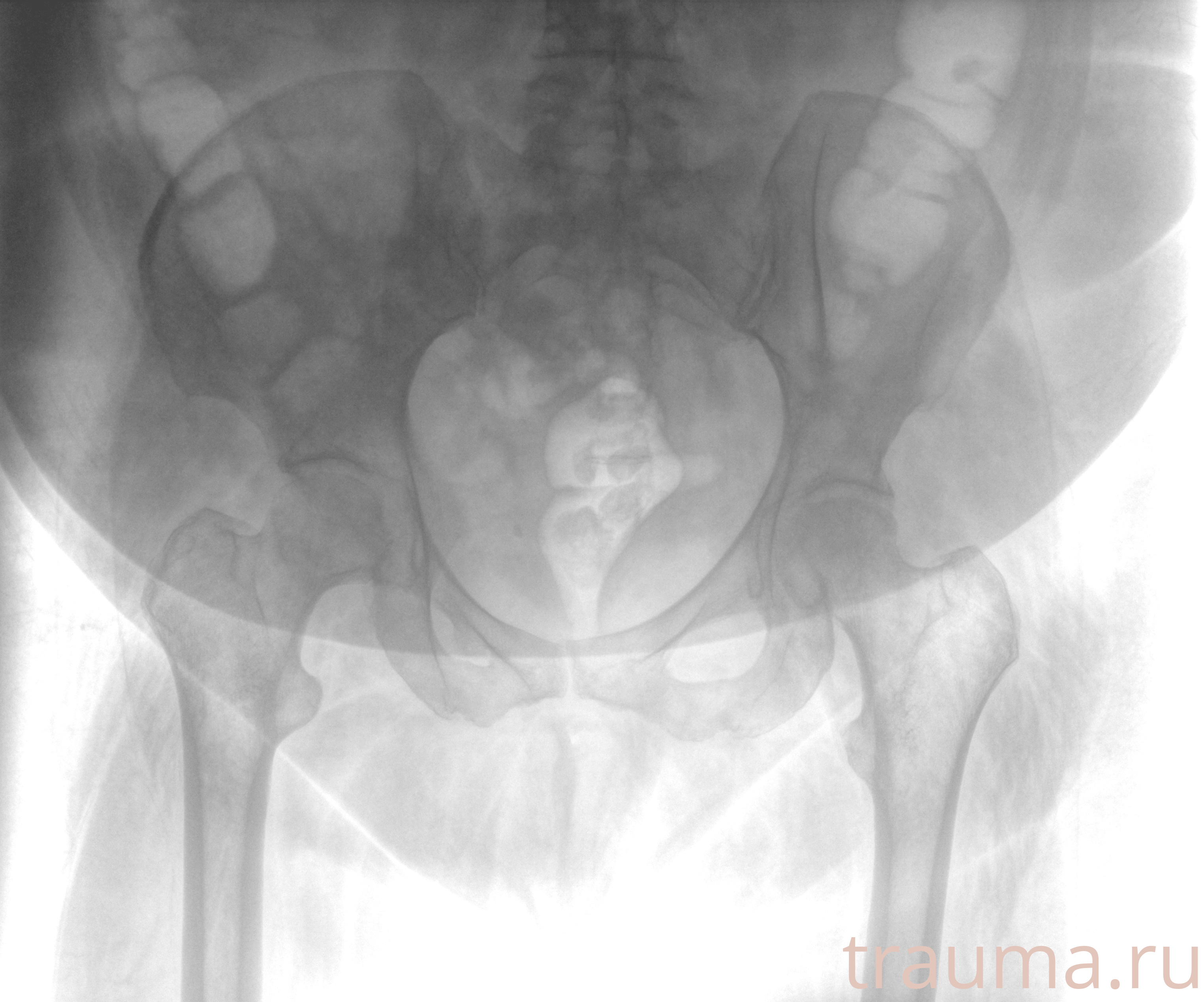 Рентген на дому: по вашему адресу приезжает врач-рентгенолог, травматолог-ортопед с мобильным рентгеновским аппаратом, проводит диагностику травмы или заболевания, делает необходимые рентгенограммы, дает рекомендации по дальнейшему лечению. Получить качественные снимки в домашних условиях возможно благодаря уникальной методике, разработанной МосРентген Центром для института  Склифосовского