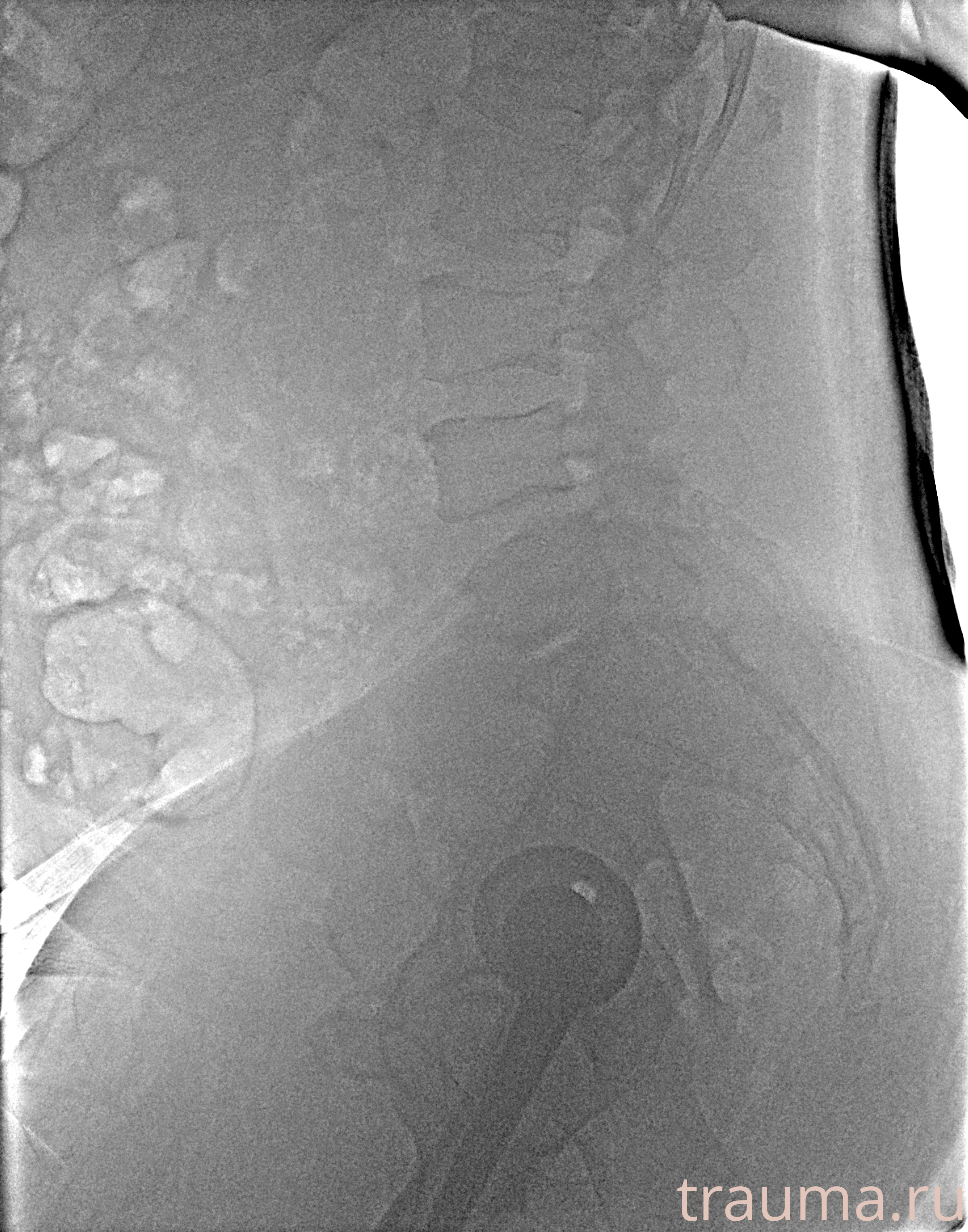 Рентген на дому: по вашему адресу приезжает врач-рентгенолог, травматолог-ортопед с мобильным рентгеновским аппаратом, проводит диагностику травмы или заболевания, делает необходимые рентгенограммы, дает рекомендации по дальнейшему лечению. Получить качественные снимки в домашних условиях возможно благодаря уникальной методике, разработанной МосРентген Центром для института  Склифосовского