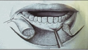 Злокачественные новообразования губы