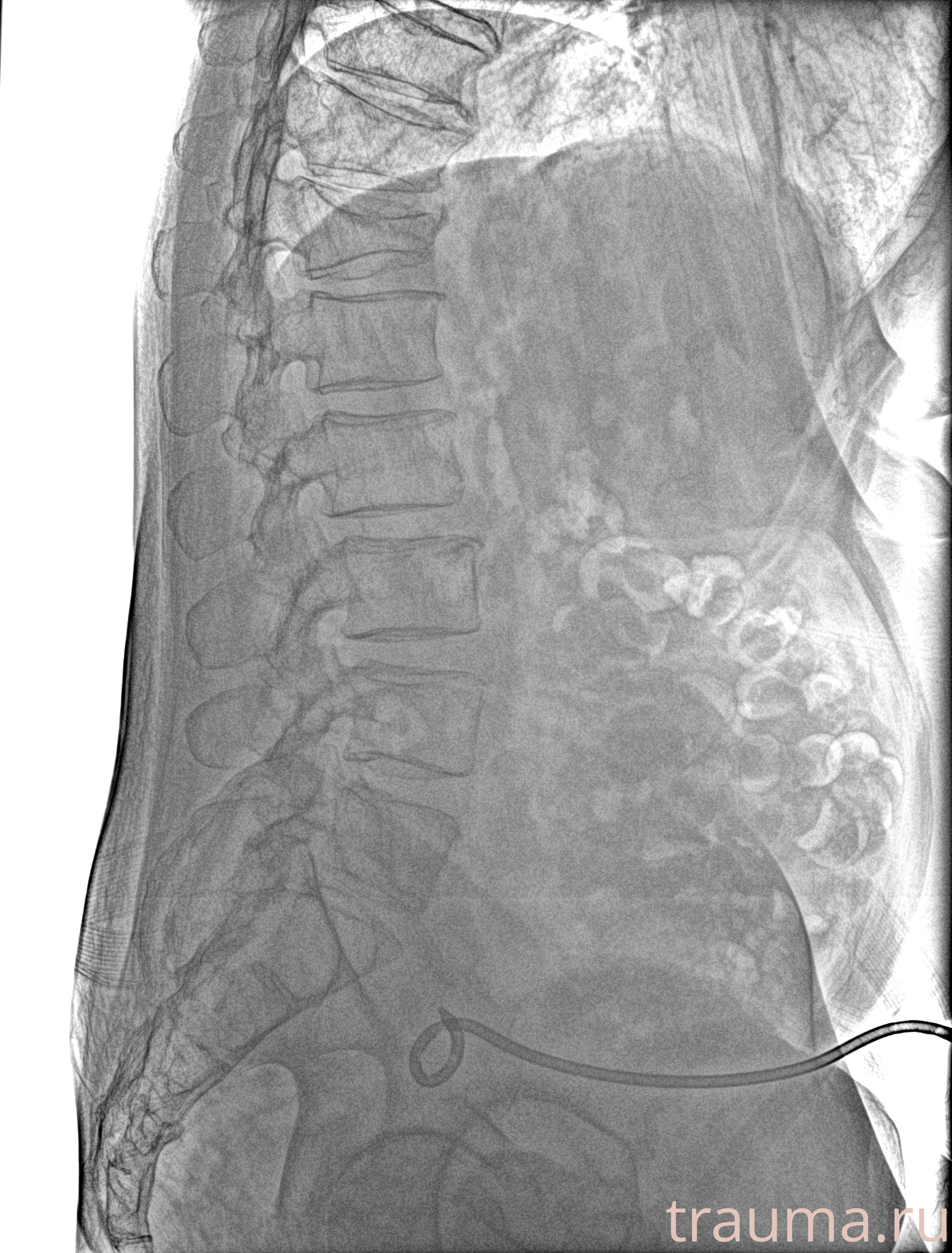 Рентген на дому: по вашему адресу приезжает врач-рентгенолог, травматолог-ортопед с мобильным рентгеновским аппаратом, проводит диагностику травмы или заболевания, делает необходимые рентгенограммы, дает рекомендации по дальнейшему лечению. Получить качественные снимки в домашних условиях возможно благодаря уникальной методике, разработанной МосРентген Центром для института  Склифосовского