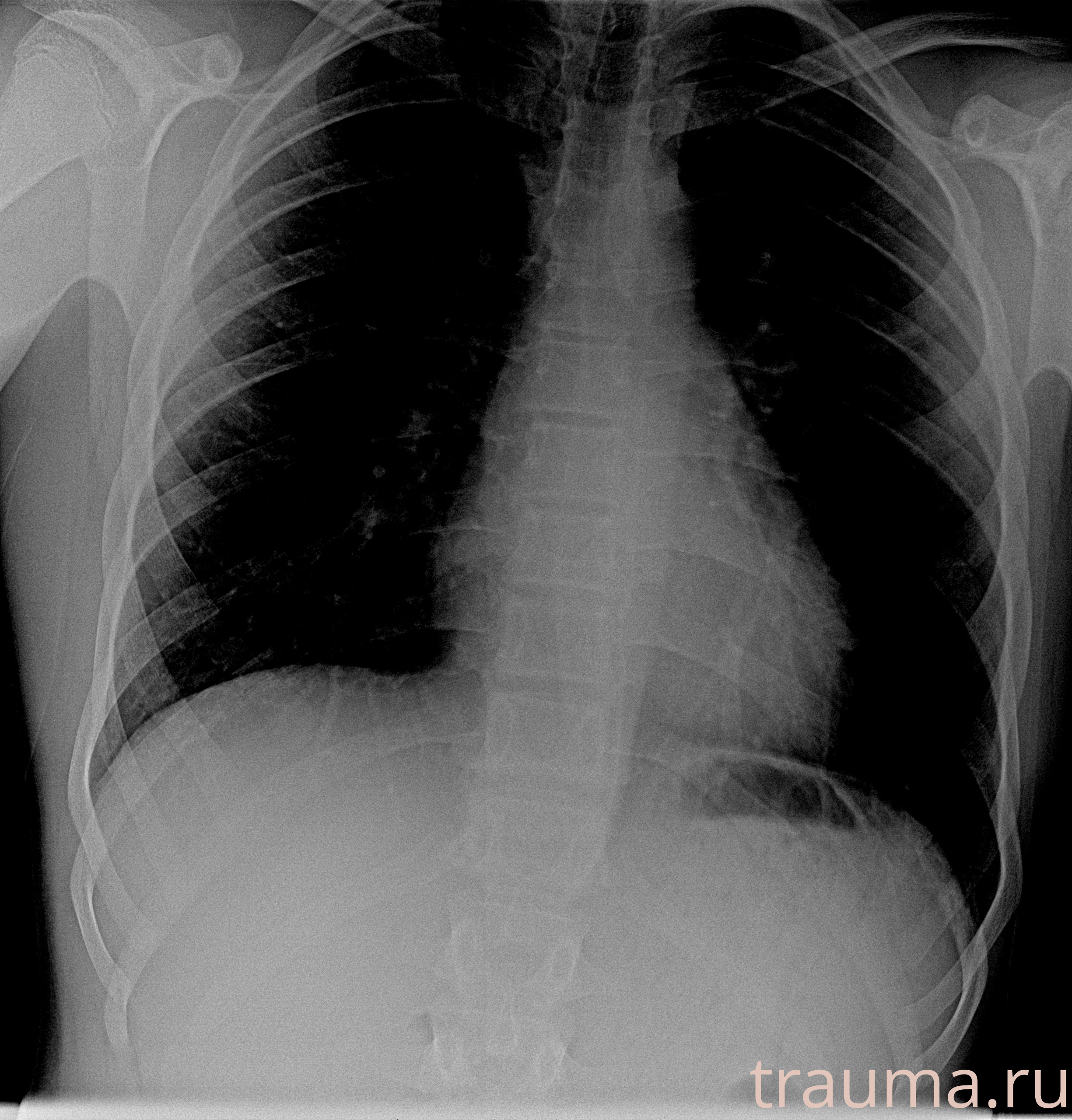 Рентген на дому: по вашему адресу приезжает врач-рентгенолог, травматолог-ортопед с мобильным рентгеновским аппаратом, проводит диагностику травмы или заболевания, делает необходимые рентгенограммы, дает рекомендации по дальнейшему лечению. Получить качественные снимки в домашних условиях возможно благодаря уникальной методике, разработанной МосРентген Центром для института  Склифосовского