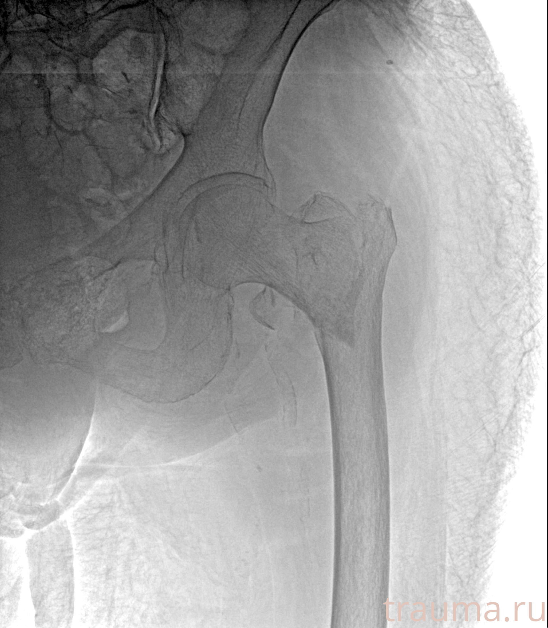 Рентген на дому: по вашему адресу приезжает врач-рентгенолог, травматолог-ортопед с мобильным рентгеновским аппаратом, проводит диагностику травмы или заболевания, делает необходимые рентгенограммы, дает рекомендации по дальнейшему лечению. Получить качественные снимки в домашних условиях возможно благодаря уникальной методике, разработанной МосРентген Центром для института  Склифосовского