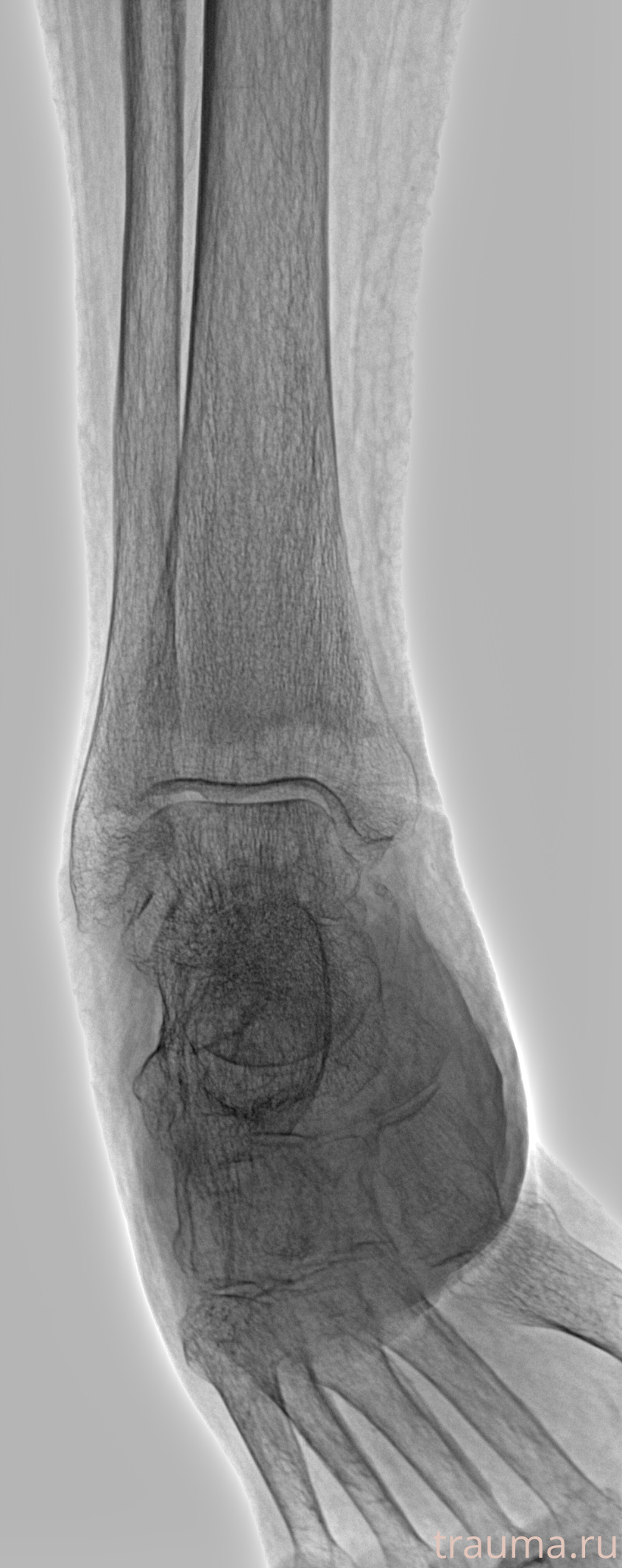 Рентген на дому: по вашему адресу приезжает врач-рентгенолог, травматолог-ортопед с мобильным рентгеновским аппаратом, проводит диагностику травмы или заболевания, делает необходимые рентгенограммы, дает рекомендации по дальнейшему лечению. Получить качественные снимки в домашних условиях возможно благодаря уникальной методике, разработанной МосРентген Центром для института  Склифосовского