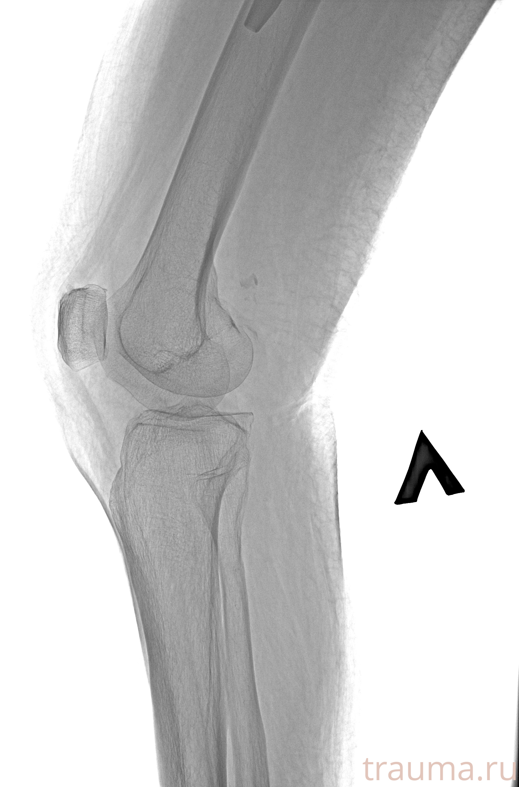 Рентген на дому: по вашему адресу приезжает врач-рентгенолог, травматолог-ортопед с мобильным рентгеновским аппаратом, проводит диагностику травмы или заболевания, делает необходимые рентгенограммы, дает рекомендации по дальнейшему лечению. Получить качественные снимки в домашних условиях возможно благодаря уникальной методике, разработанной МосРентген Центром для института  Склифосовского