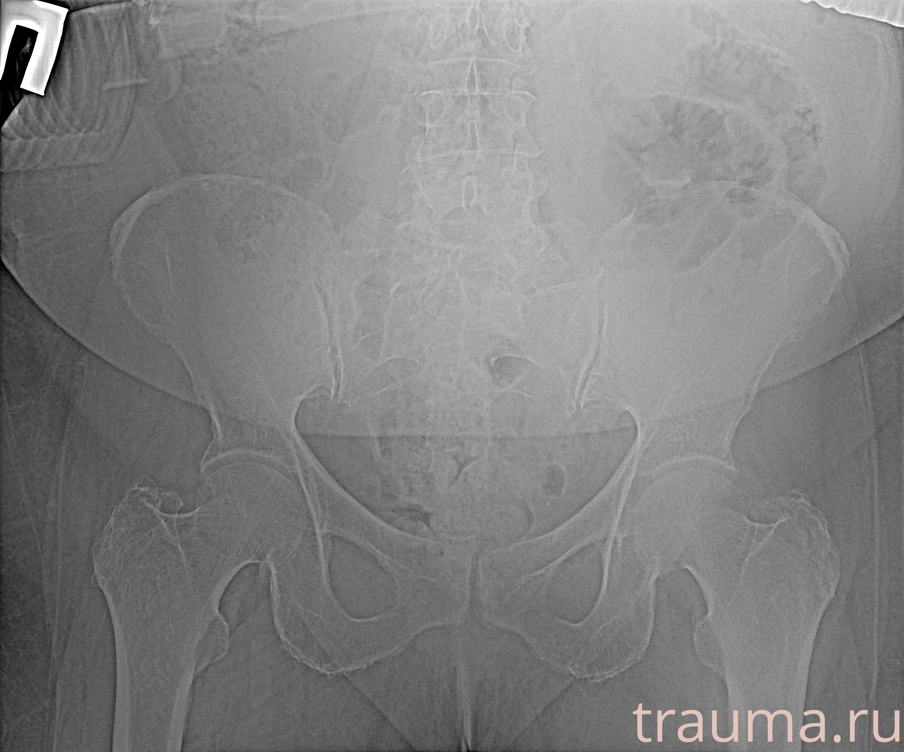 Рентген на дому: по вашему адресу приезжает врач-рентгенолог, травматолог-ортопед с мобильным рентгеновским аппаратом, проводит диагностику травмы или заболевания, делает необходимые рентгенограммы, дает рекомендации по дальнейшему лечению. Получить качественные снимки в домашних условиях возможно благодаря уникальной методике, разработанной МосРентген Центром для института  Склифосовского