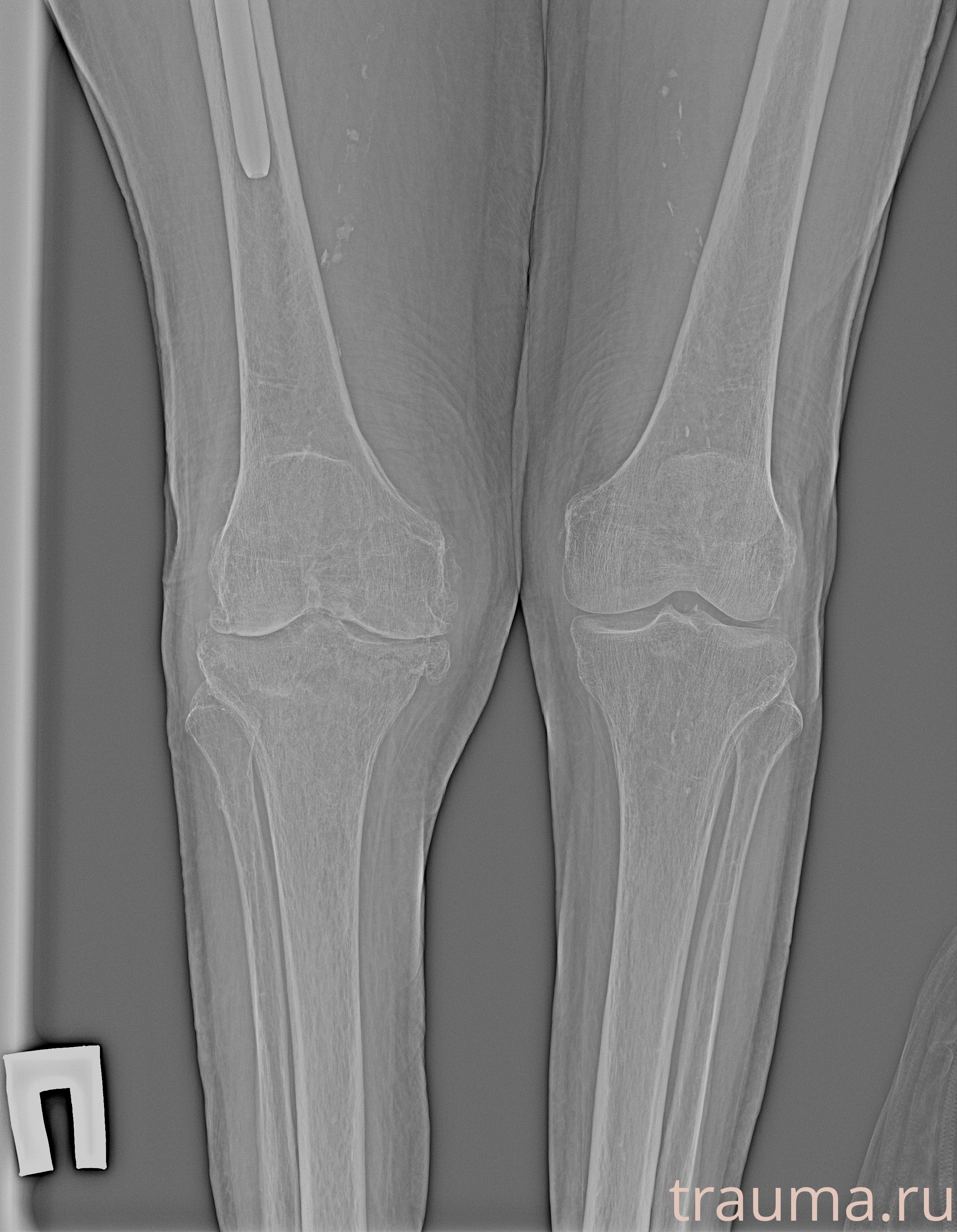 Рентген на дому: по вашему адресу приезжает врач-рентгенолог, травматолог-ортопед с мобильным рентгеновским аппаратом, проводит диагностику травмы или заболевания, делает необходимые рентгенограммы, дает рекомендации по дальнейшему лечению. Получить качественные снимки в домашних условиях возможно благодаря уникальной методике, разработанной МосРентген Центром для института  Склифосовского