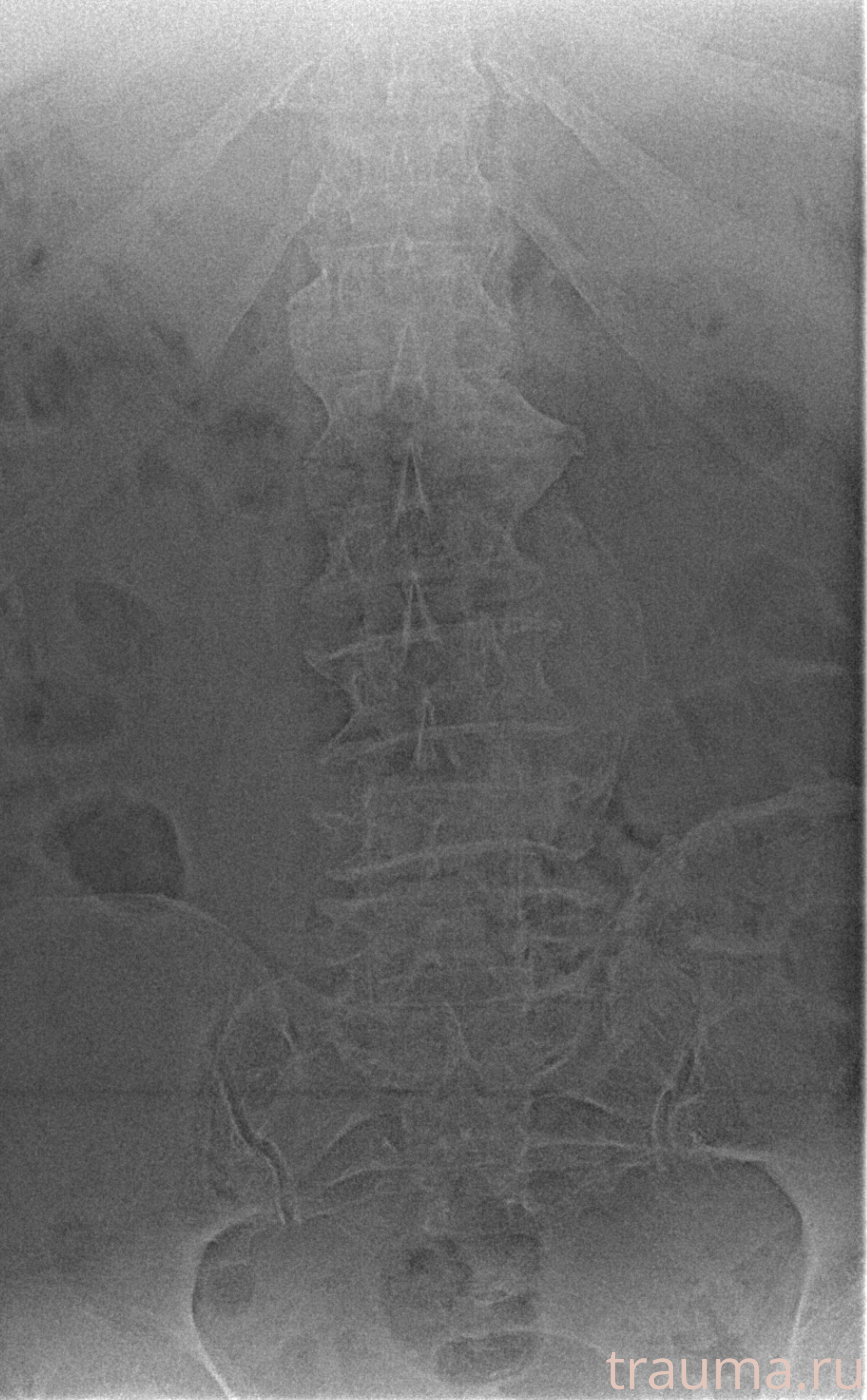 Рентген на дому: по вашему адресу приезжает врач-рентгенолог, травматолог-ортопед с мобильным рентгеновским аппаратом, проводит диагностику травмы или заболевания, делает необходимые рентгенограммы, дает рекомендации по дальнейшему лечению. Получить качественные снимки в домашних условиях возможно благодаря уникальной методике, разработанной МосРентген Центром для института  Склифосовского