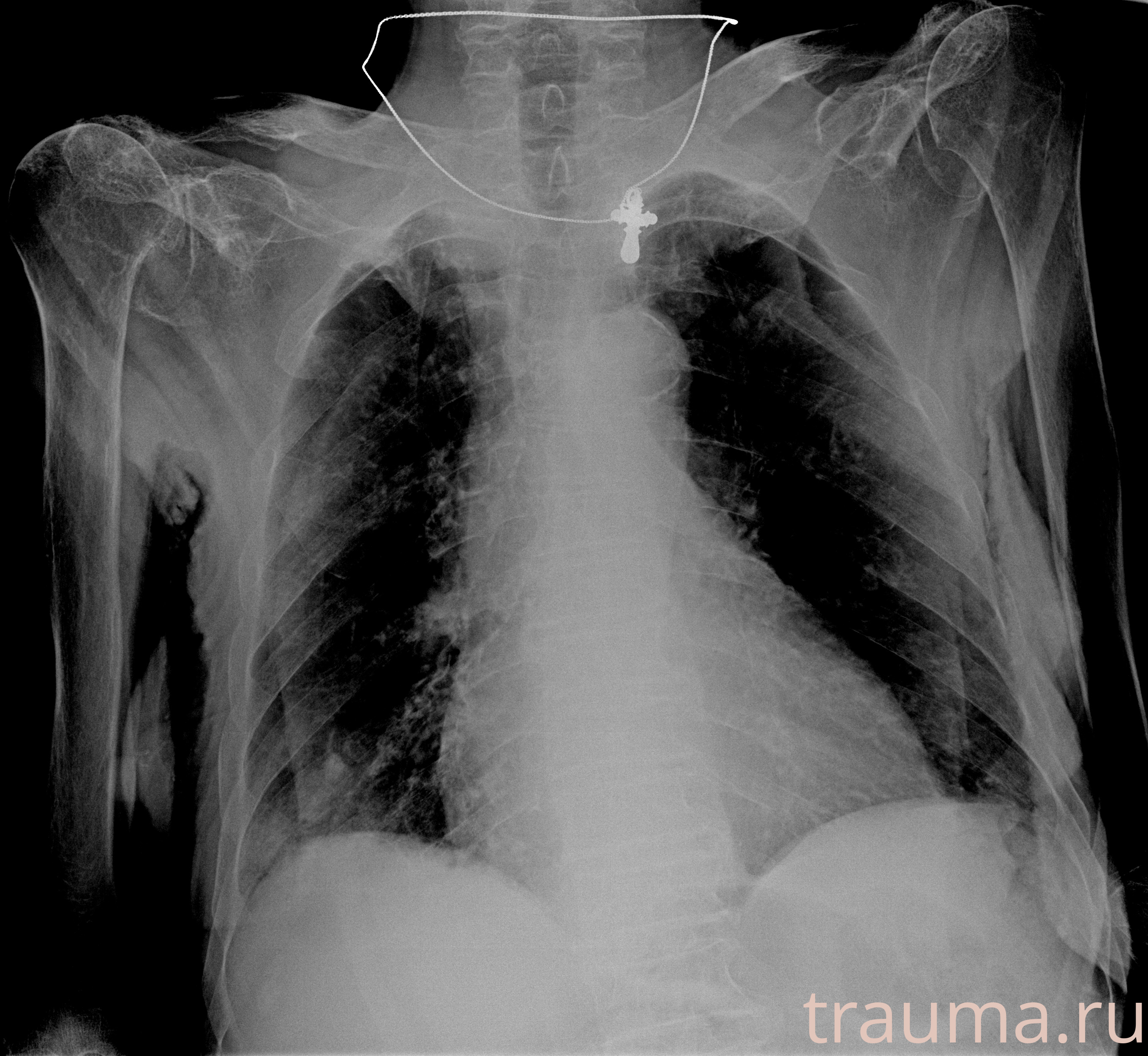 Рентген на дому: по вашему адресу приезжает врач-рентгенолог, травматолог-ортопед с мобильным рентгеновским аппаратом, проводит диагностику травмы или заболевания, делает необходимые рентгенограммы, дает рекомендации по дальнейшему лечению. Получить качественные снимки в домашних условиях возможно благодаря уникальной методике, разработанной МосРентген Центром для института  Склифосовского